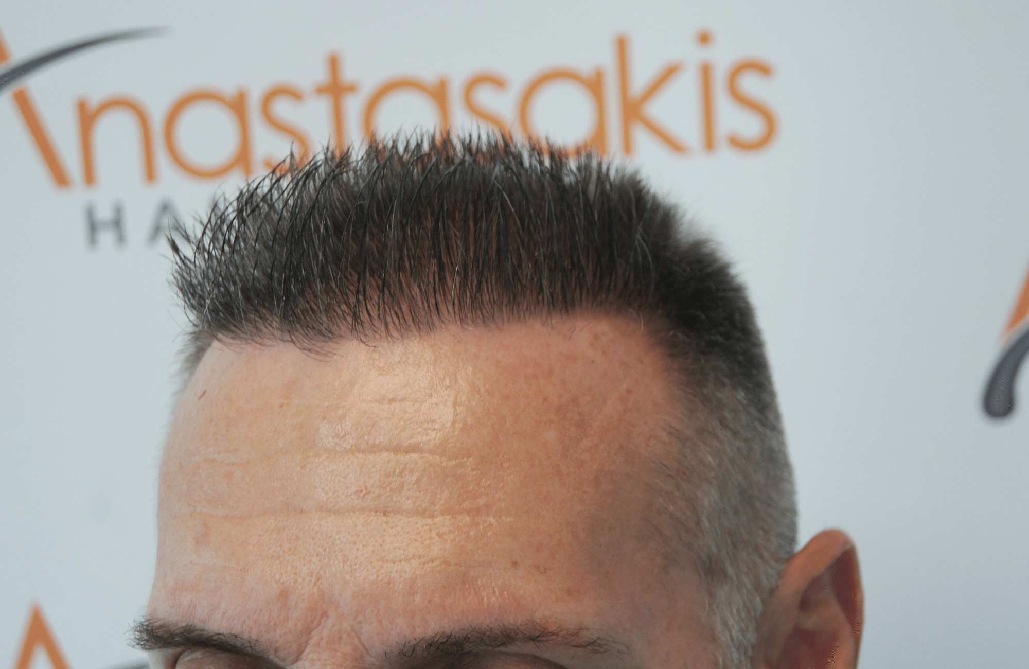 best hair transplant result with 2600 fus male fue anastasakis hair clinic