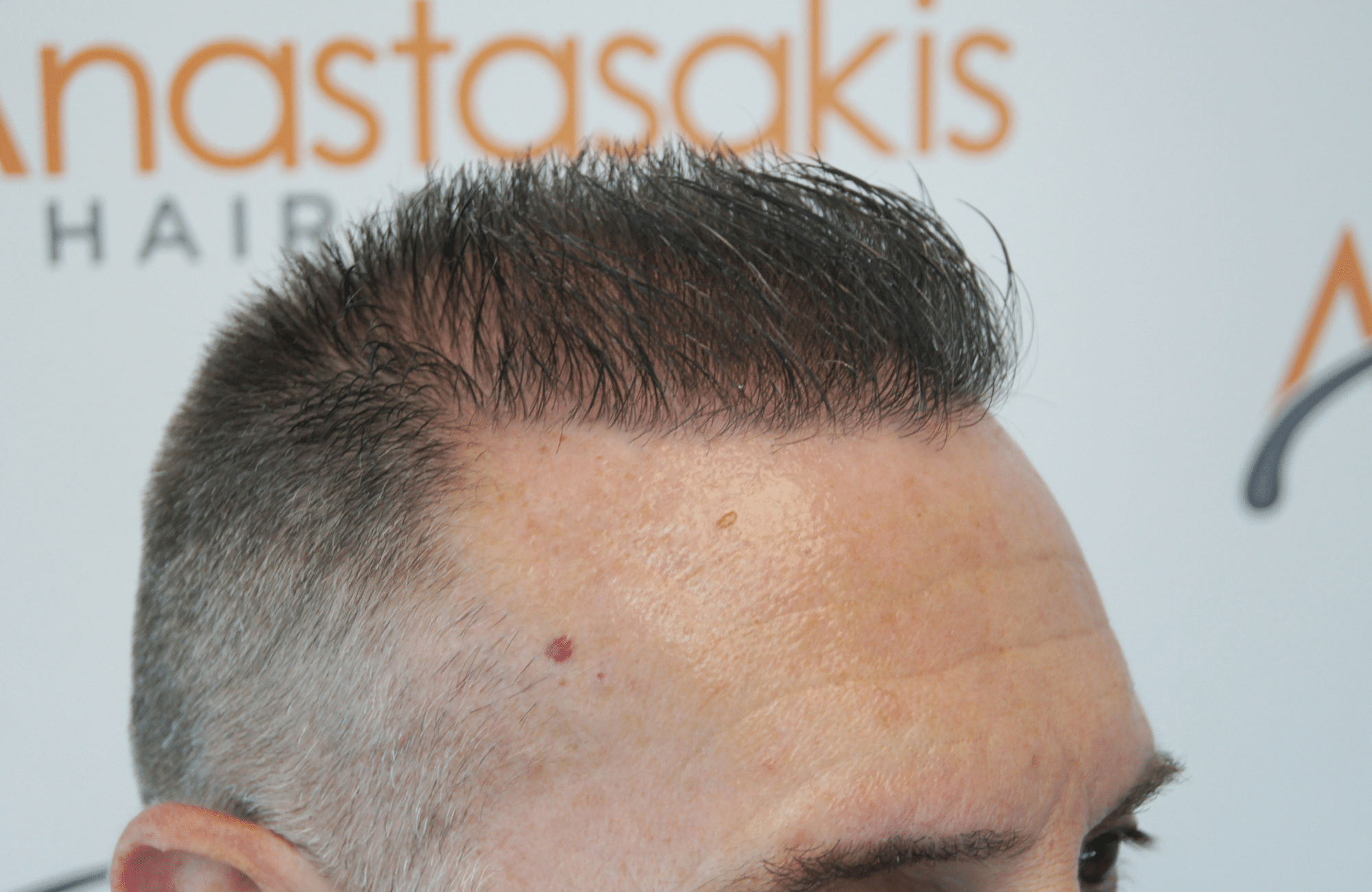 best hair transplant result with 2600 fus male fue anastasakis hair clinic