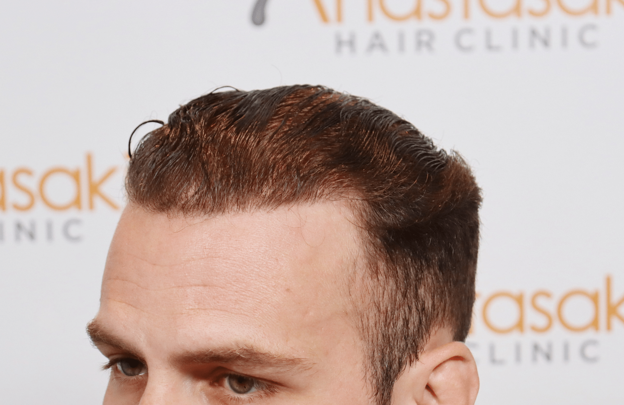 best hair transplant result with 2600 fus male fue anastasakis hair clinic