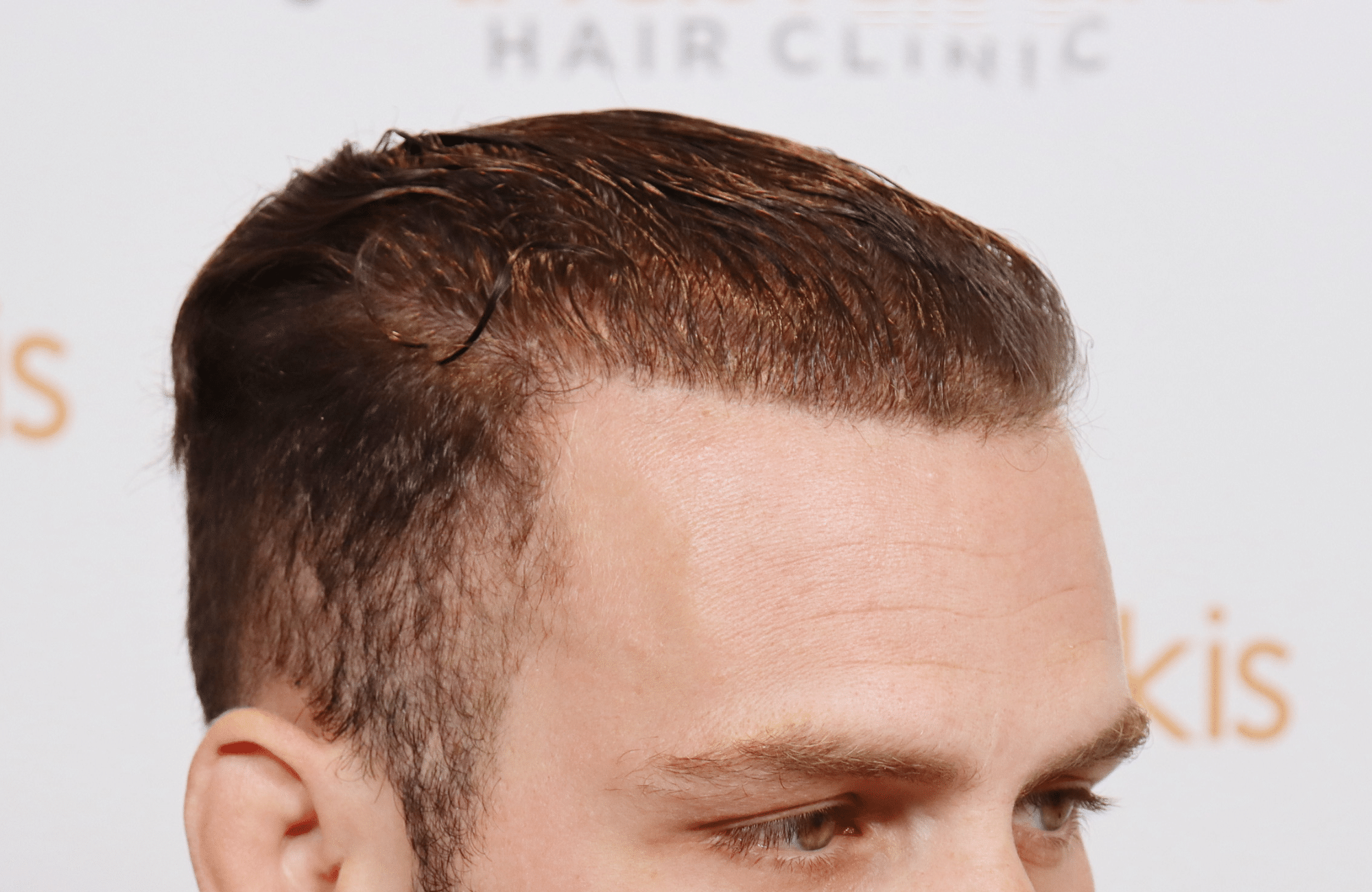 best hair transplant result with 2600 fus male fue anastasakis hair clinic