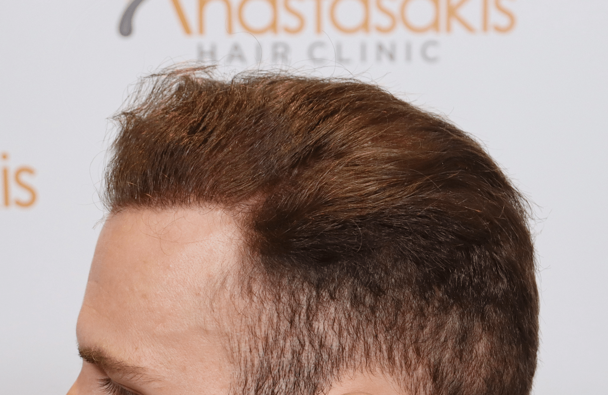 best hair transplant result with 2600 fus male fue anastasakis hair clinic