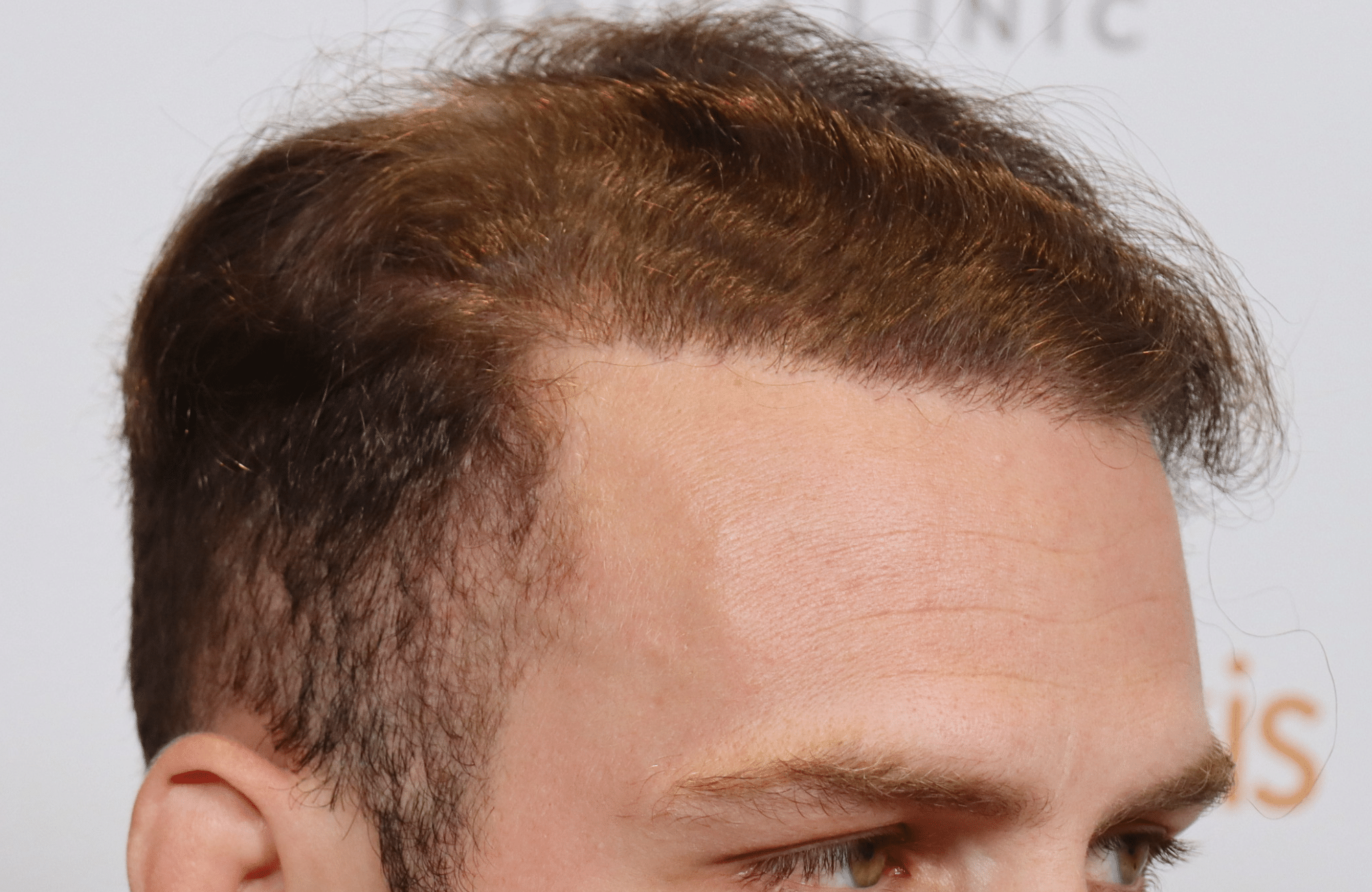 best hair transplant result with 2600 fus male fue anastasakis hair clinic