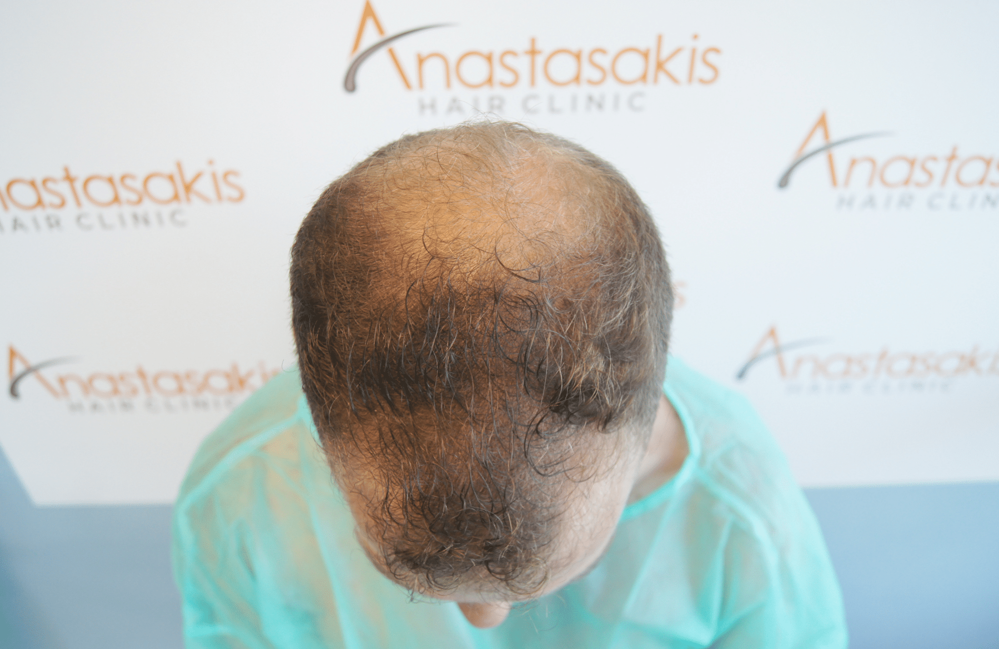best hair transplant result with 2600 fus male fue anastasakis hair clinic