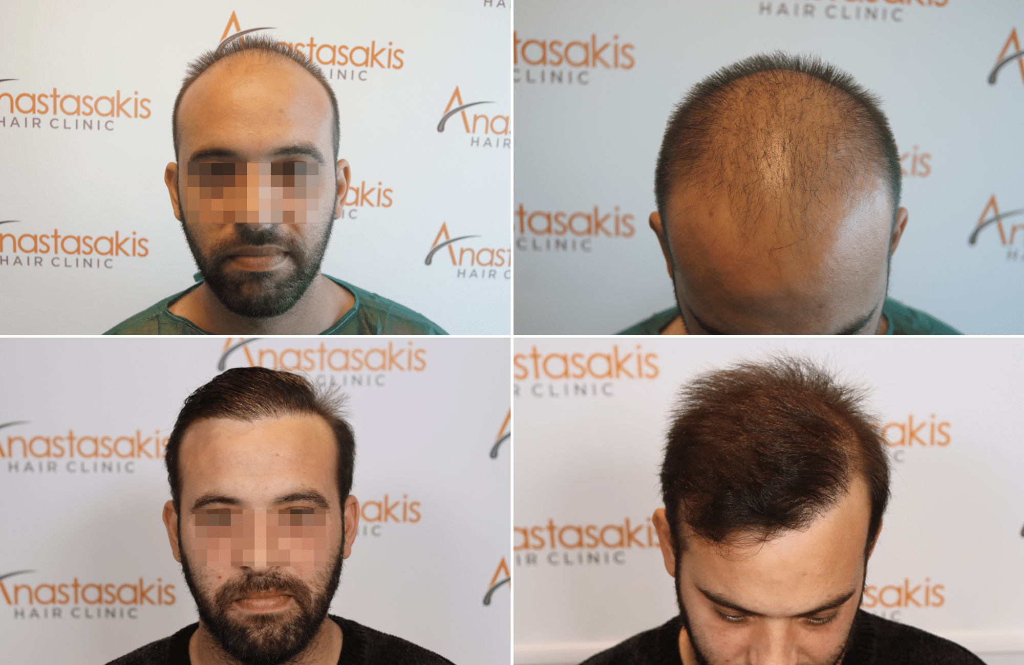 https://www.anastasakishairclinic.gr/portfolio/apotelesma-metamosxefsis-mallion-anastasakis-hair-clinic-504/