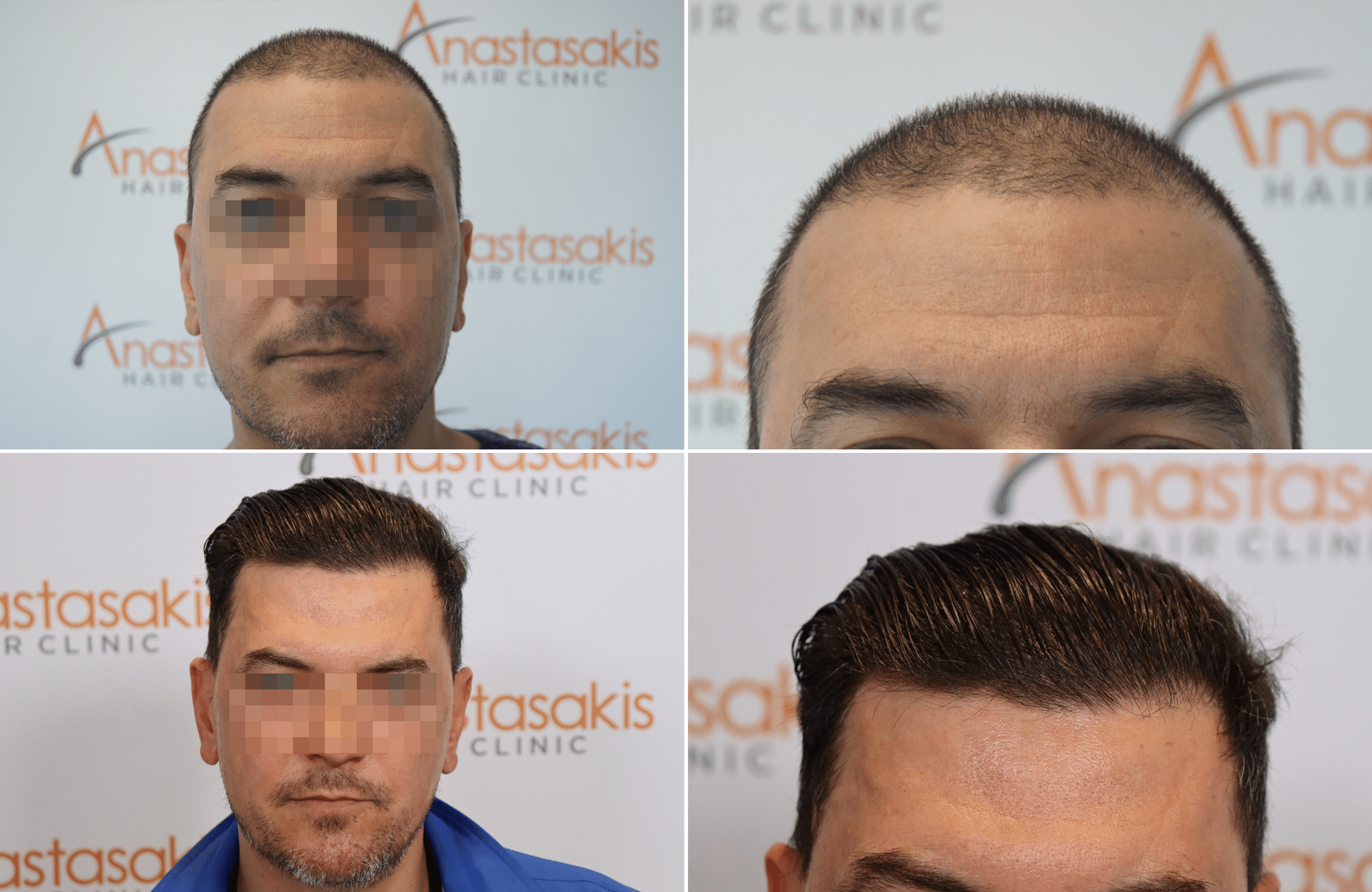 https://www.anastasakishairclinic.gr/portfolio/apotelesma-metamosxefsis-mallion-anastasakis-hair-clinic-503/