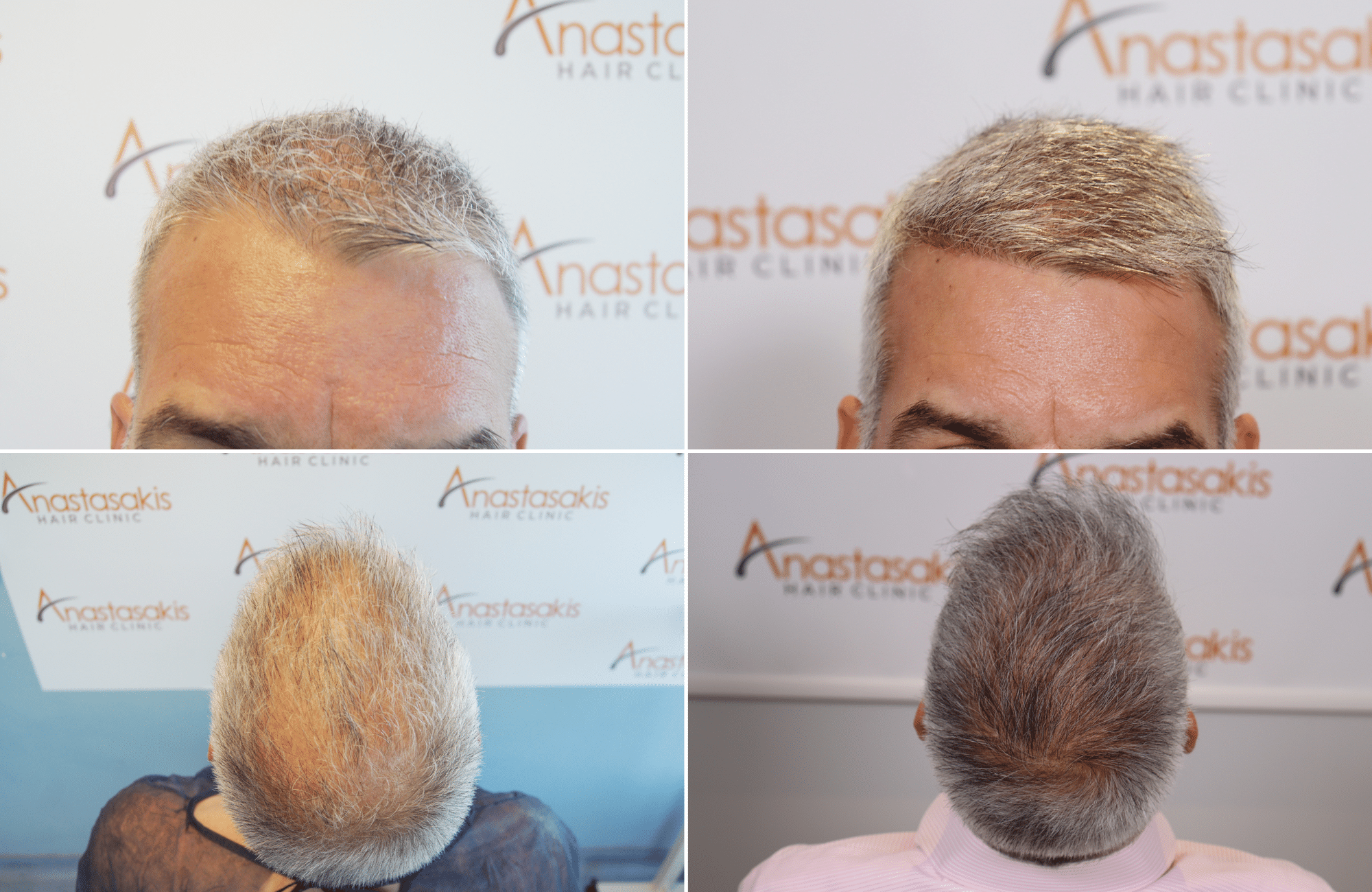https://www.anastasakishairclinic.gr/portfolio/apotelesma-metamosxefsis-mallion-anastasakis-hair-clinic-502/