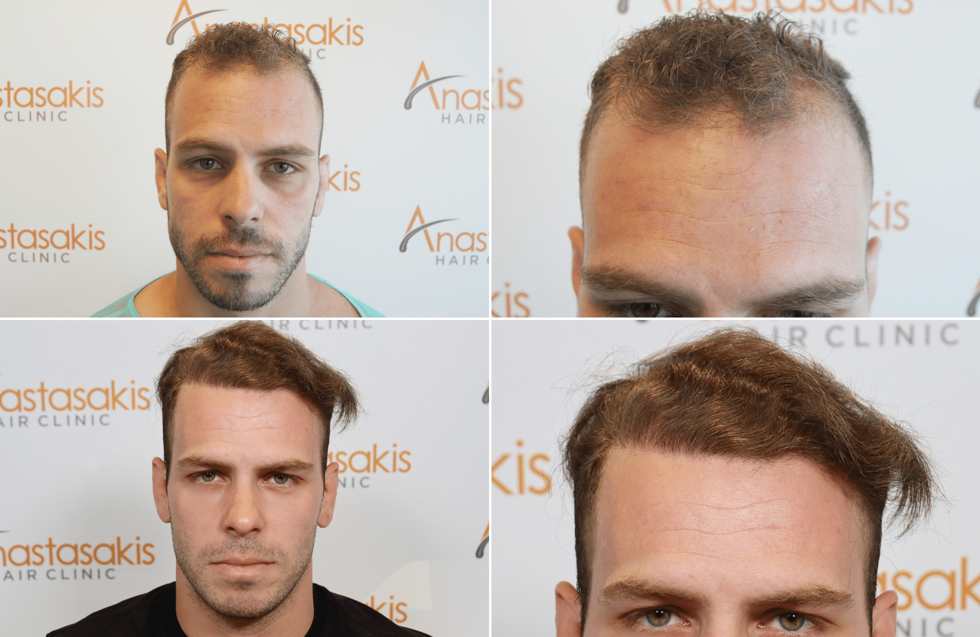 hair transplant result