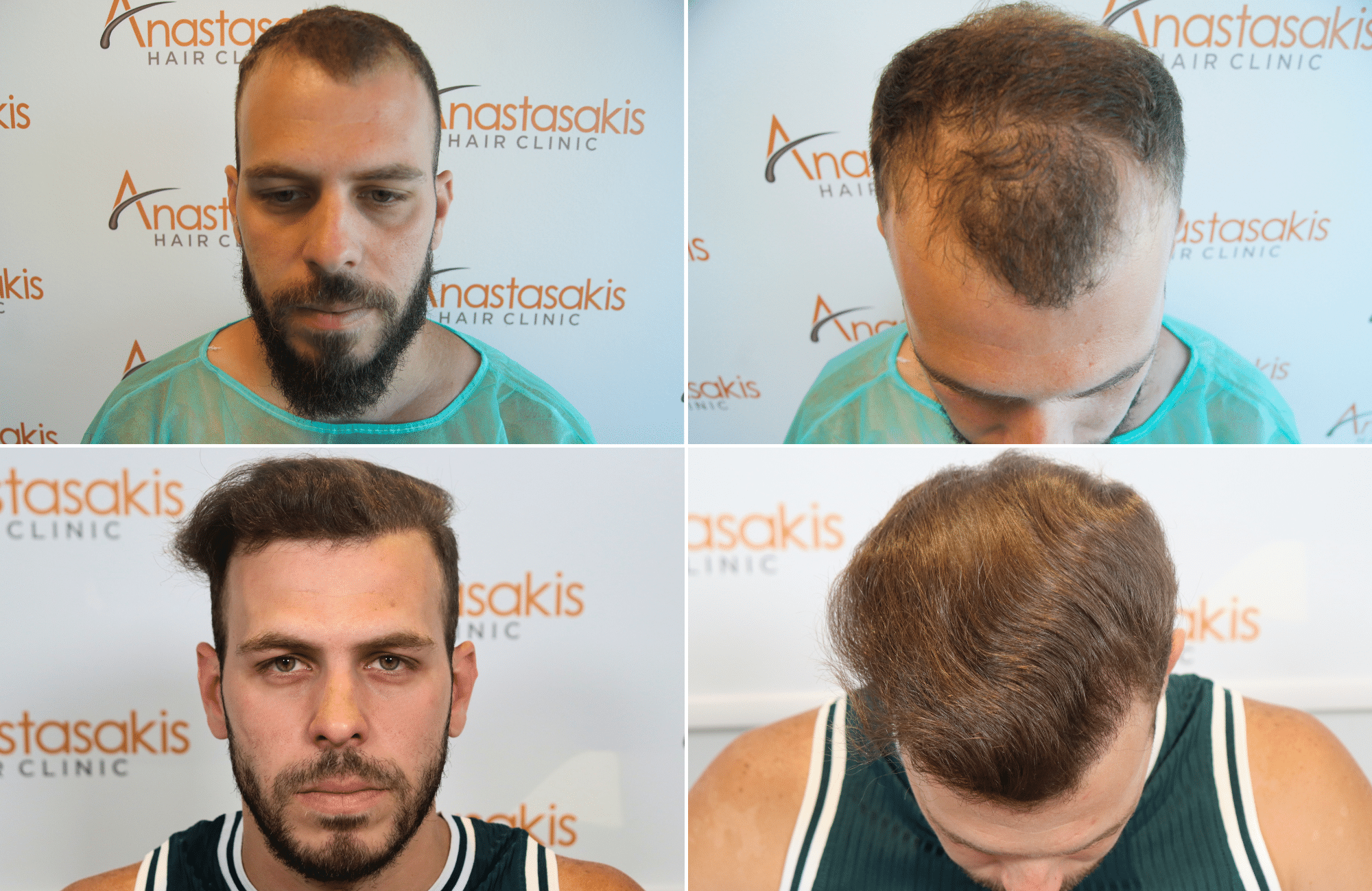 hair transplant result