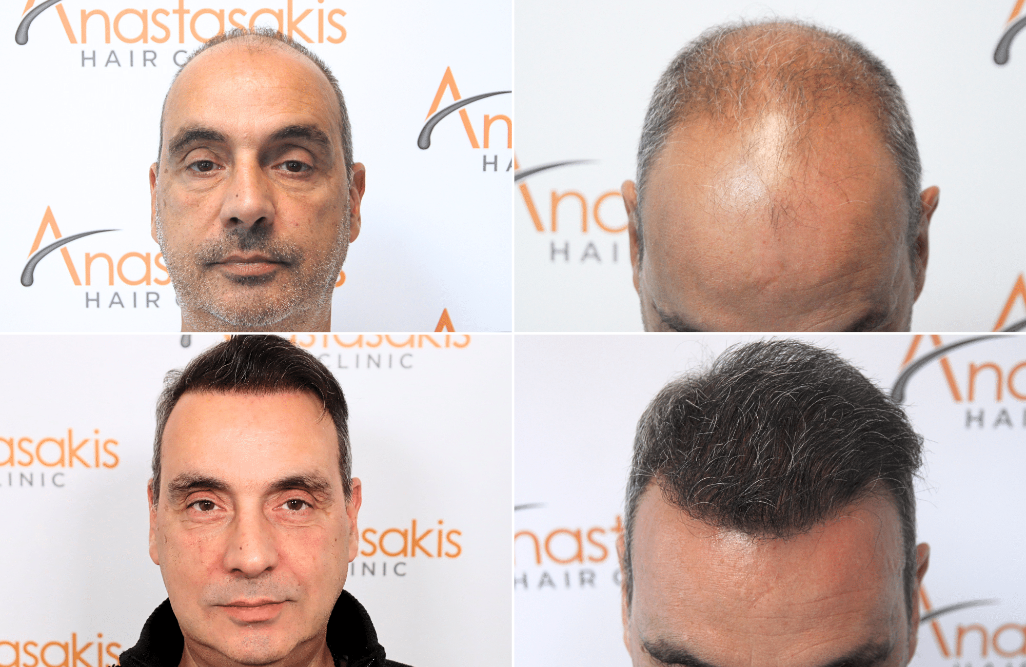 https://www.anastasakishairclinic.gr/portfolio/apotelesma-metamosxefsis-mallion-anastasakis-hair-clinic-485/