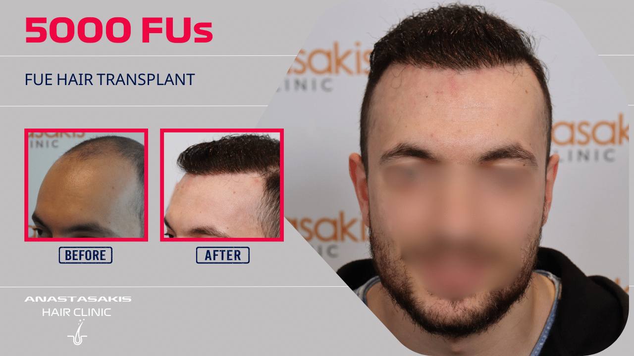 hair transplant result with 5000 fus - 2nd stage - male fue anastasakis hair clinic