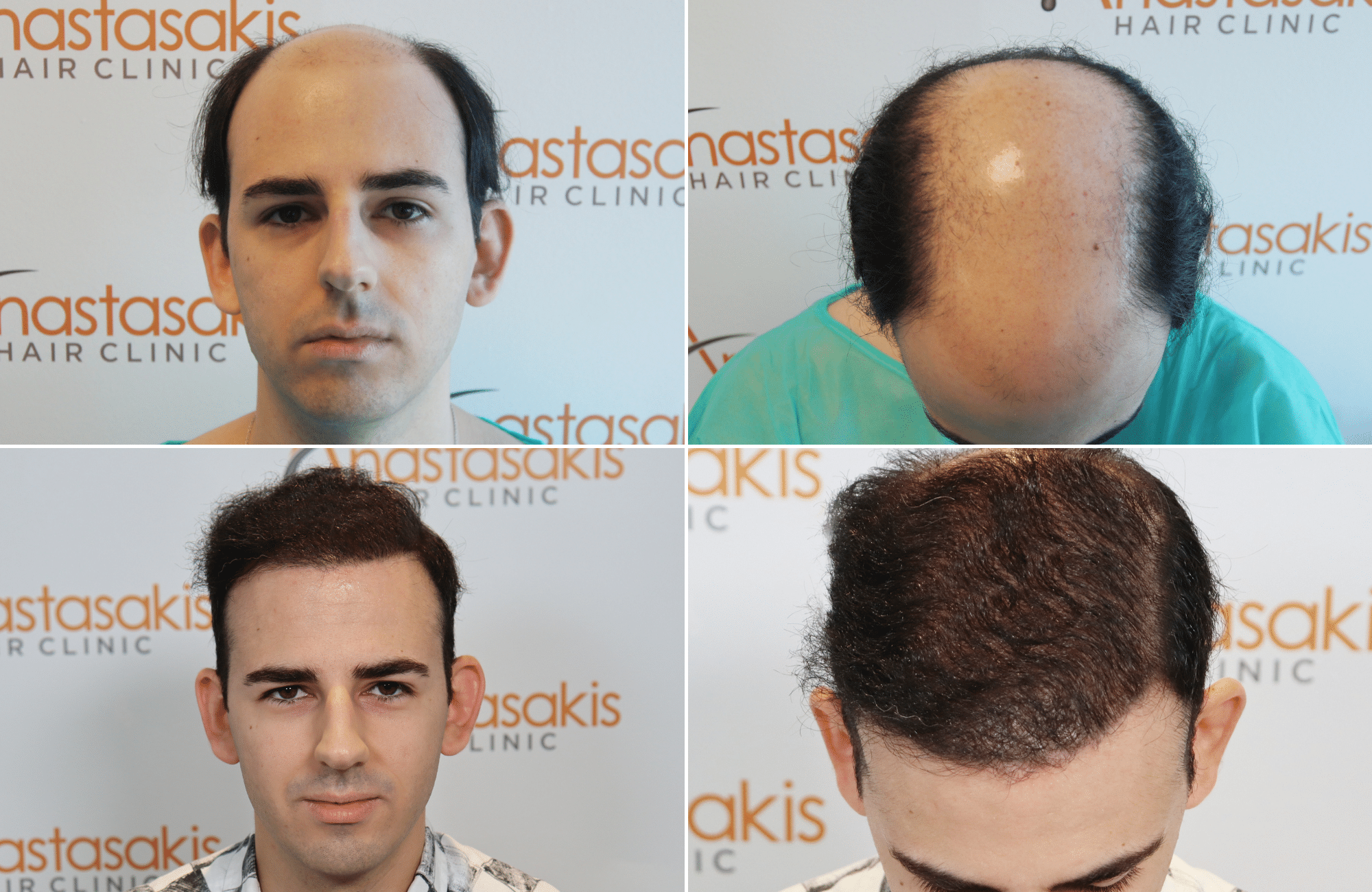 hair transplant result