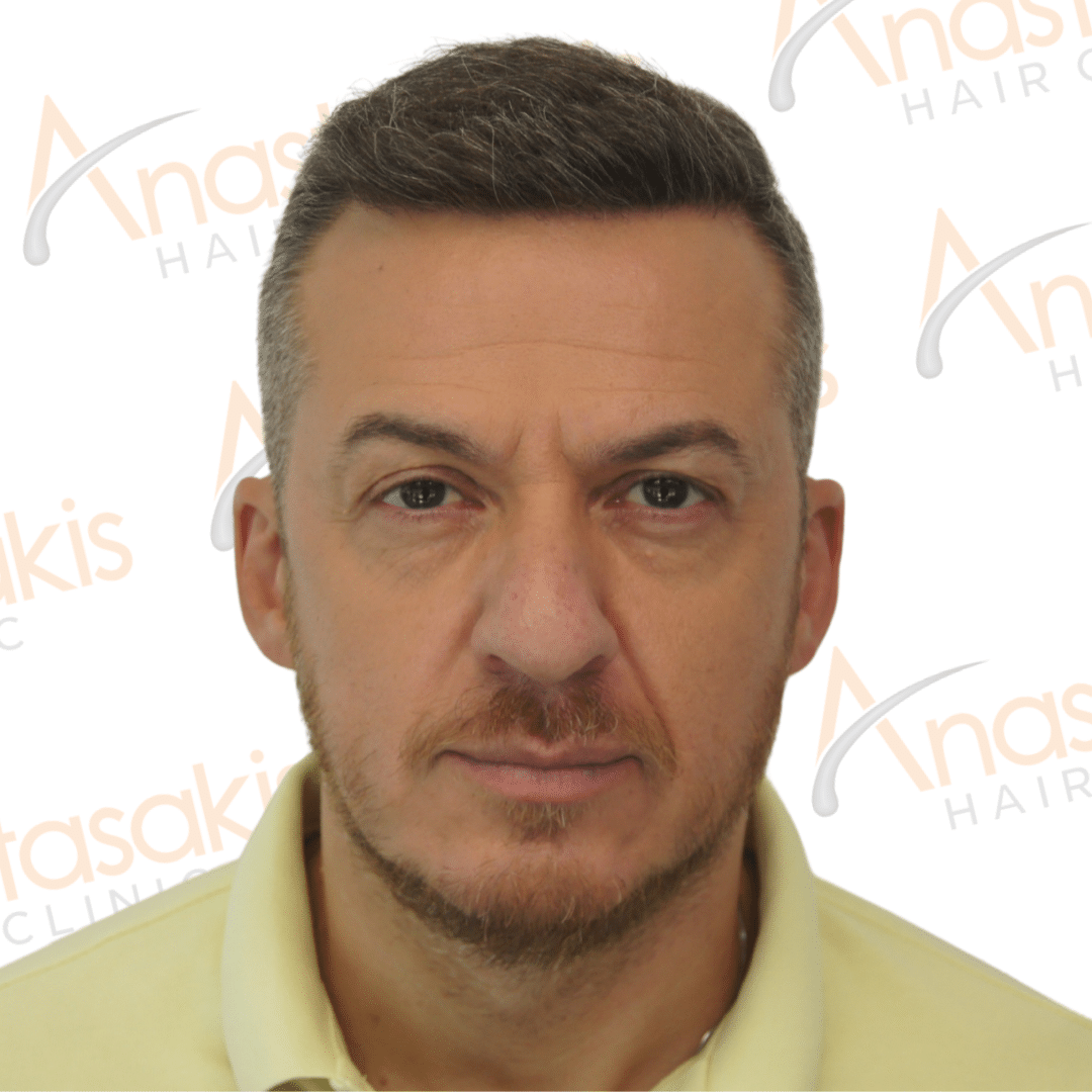 Anastasakis Hair Clinic