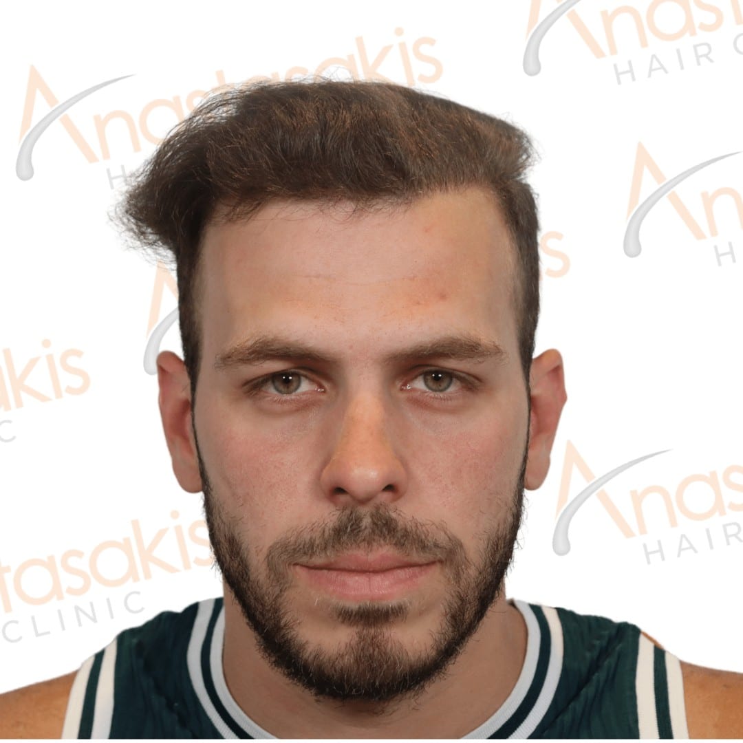 Anastasakis Hair Clinic