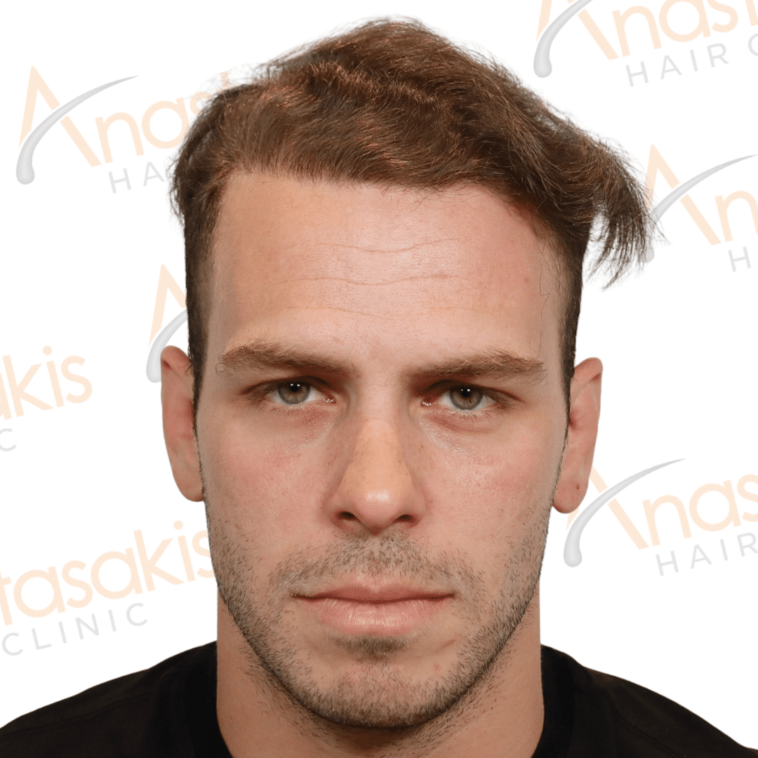 Anastasakis Hair Clinic