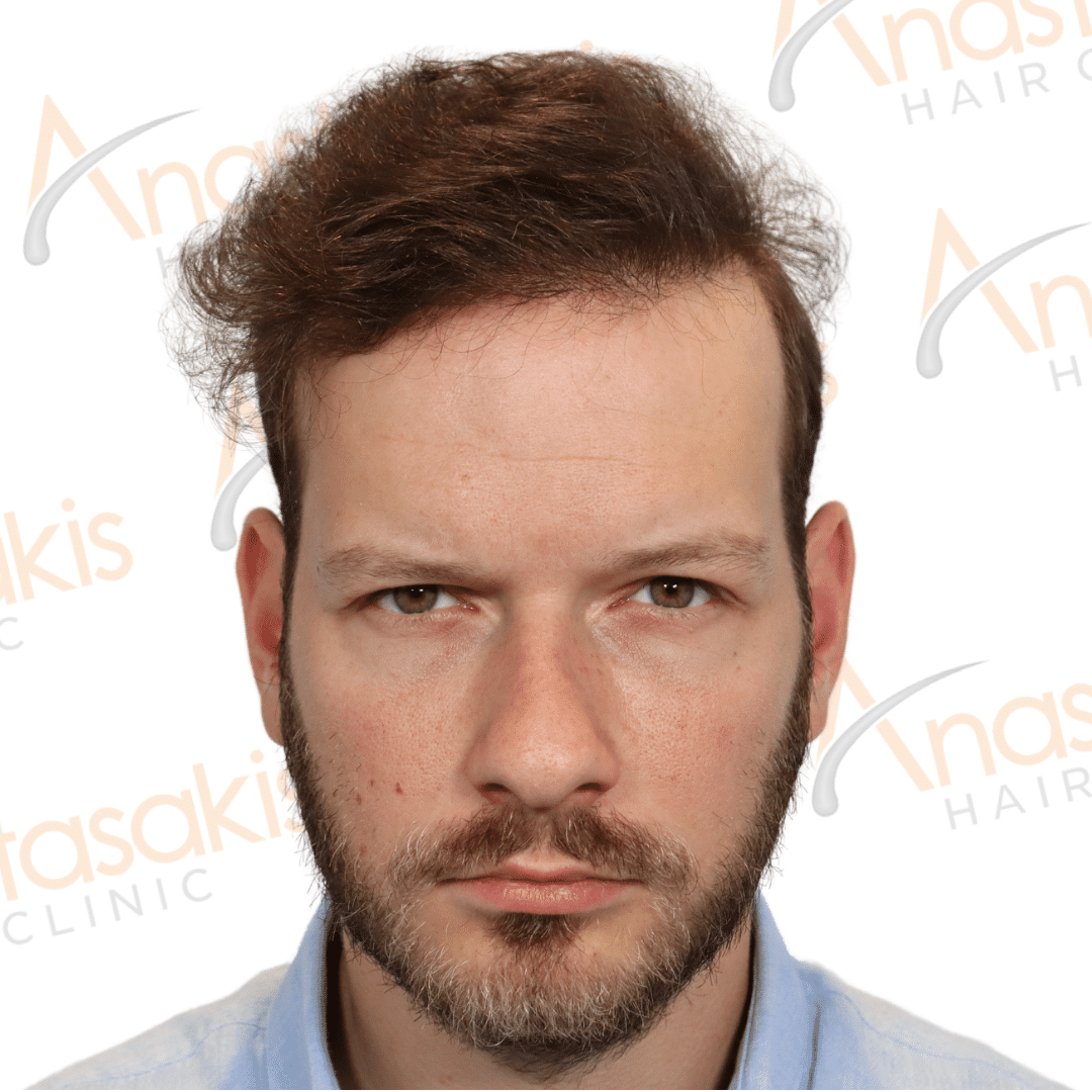 Anastasakis Hair Clinic