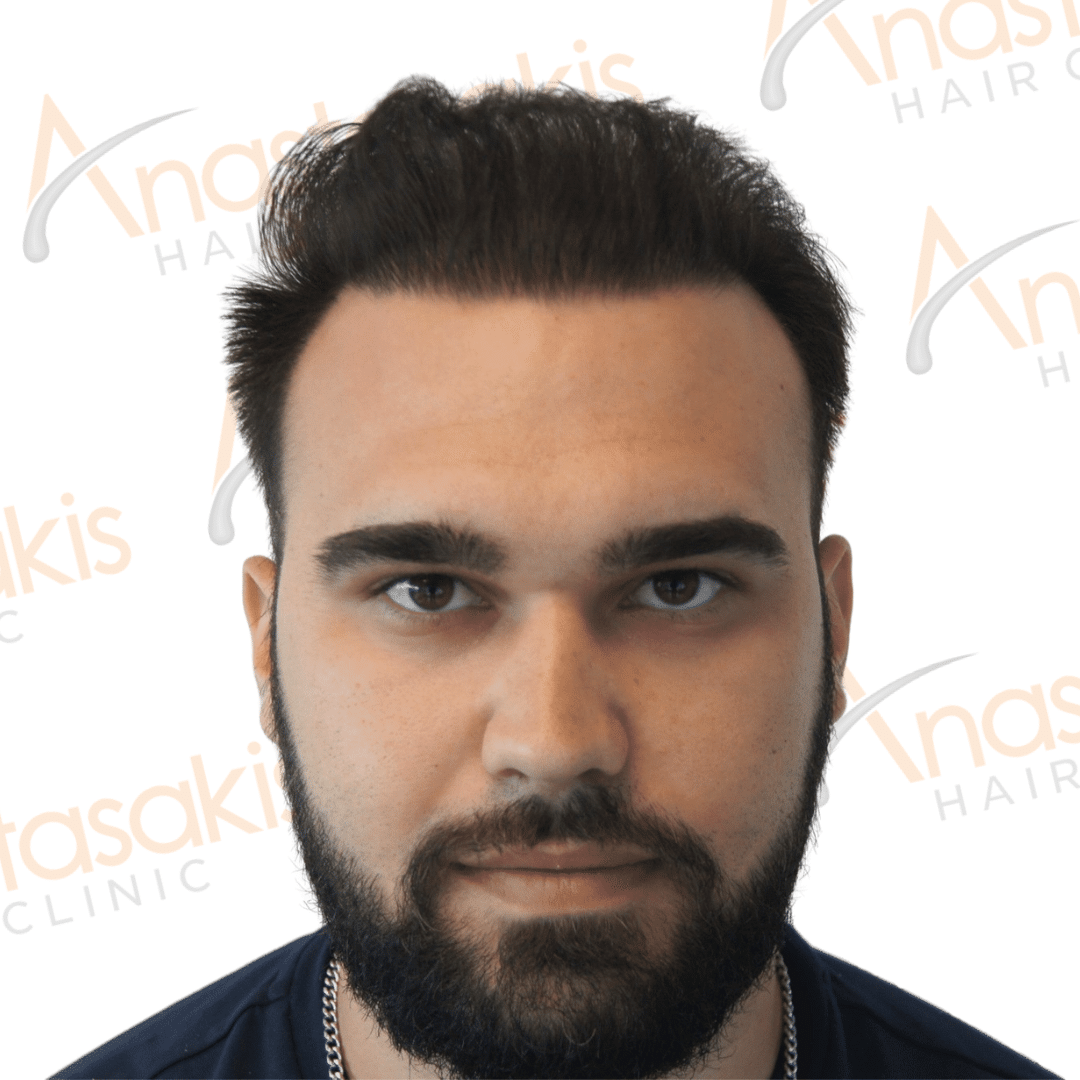 Anastasakis Hair Clinic