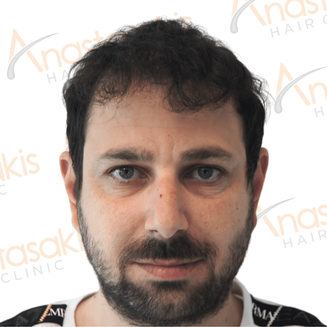 Anastasakis Hair Clinic