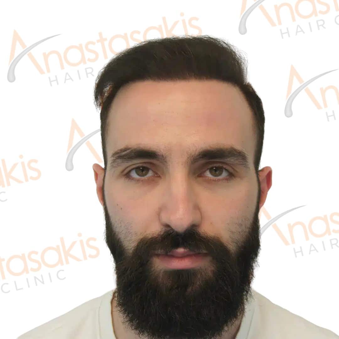 Anastasakis Hair Clinic