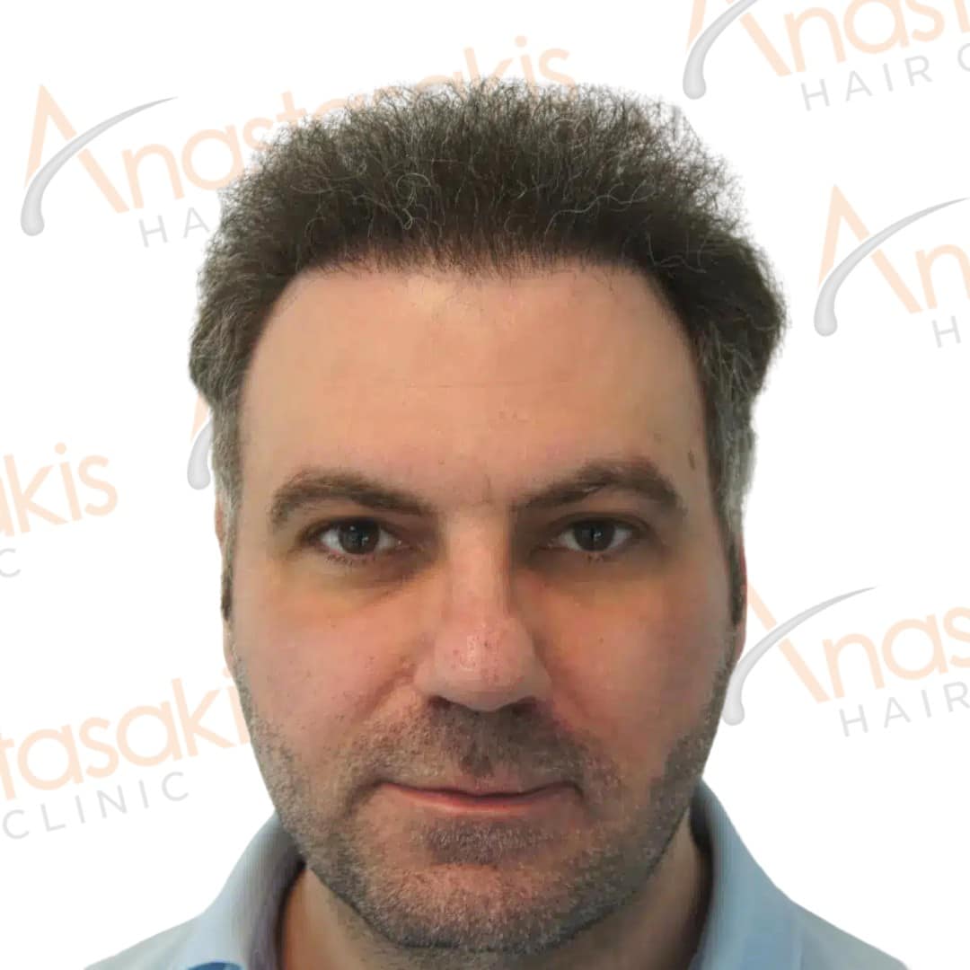 Anastasakis Hair Clinic
