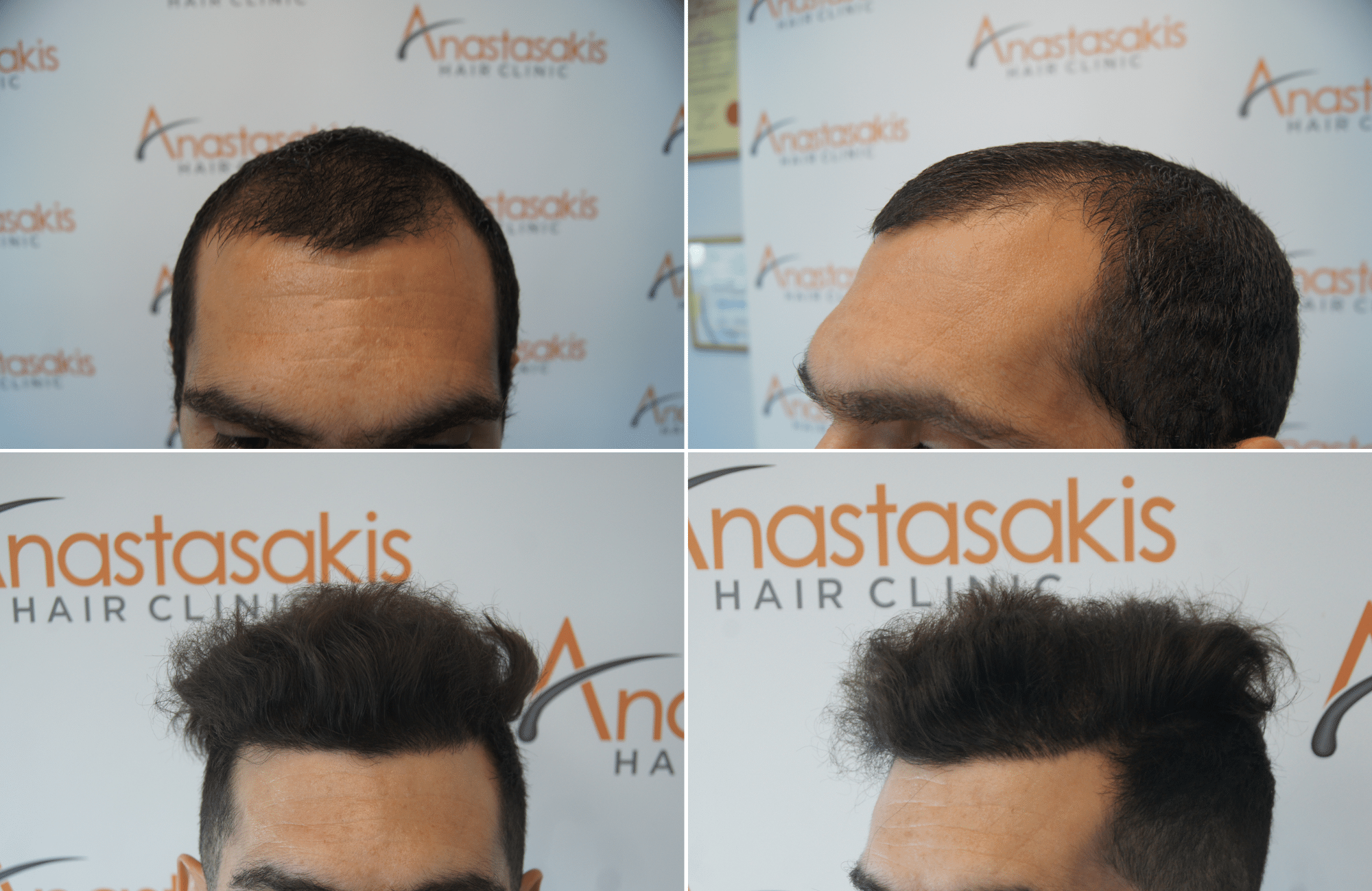 https://www.anastasakishairclinic.gr/portfolio/apotelesma-metamosxefsis-mallion-anastasakis-hair-clinic-553/