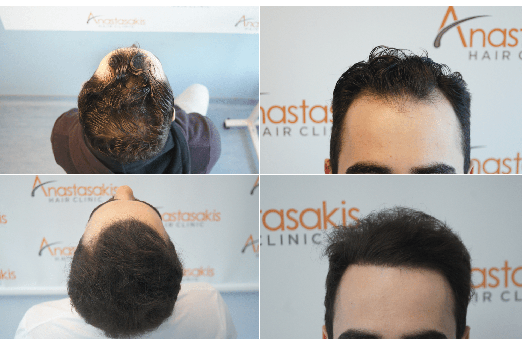 https://www.anastasakishairclinic.gr/portfolio/apotelesma-metamosxefsis-mallion-anastasakis-hair-clinic-551/