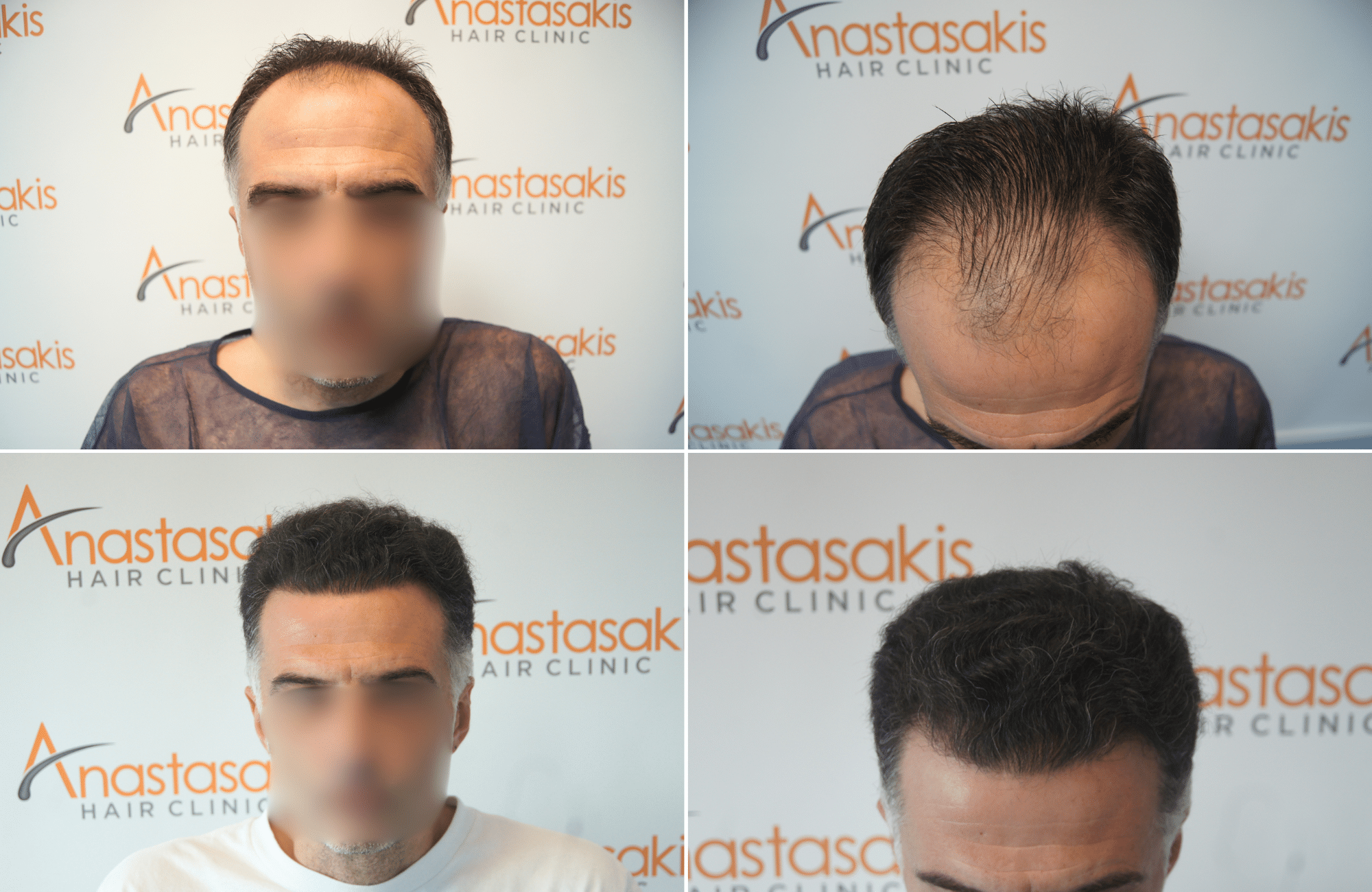 https://www.anastasakishairclinic.gr/portfolio/apotelesma-metamosxefsis-mallion-anastasakis-hair-clinic-544/