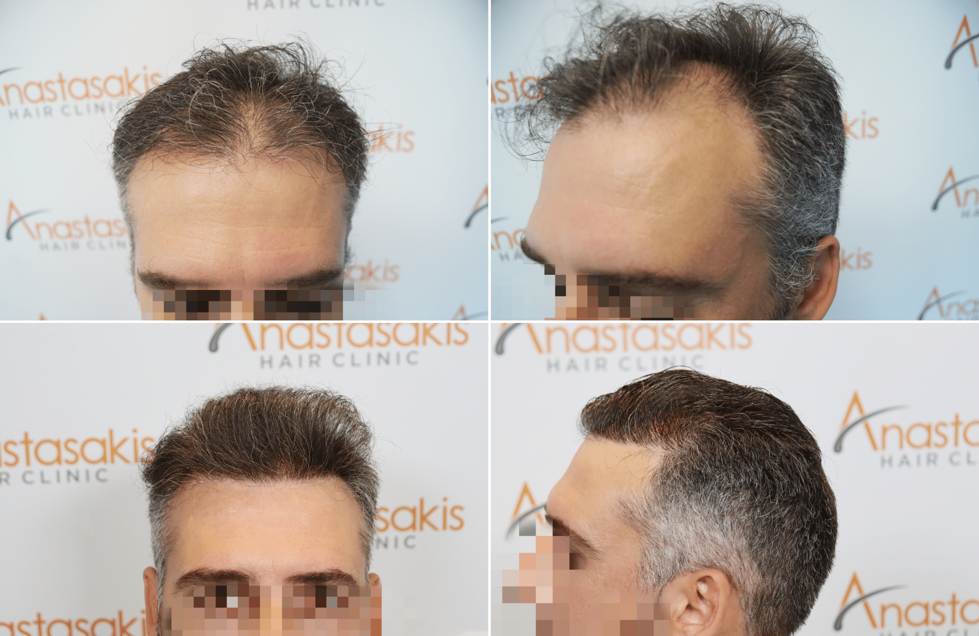 https://www.anastasakishairclinic.gr/portfolio/apotelesma-metamosxefsis-mallion-anastasakis-hair-clinic-527-2/