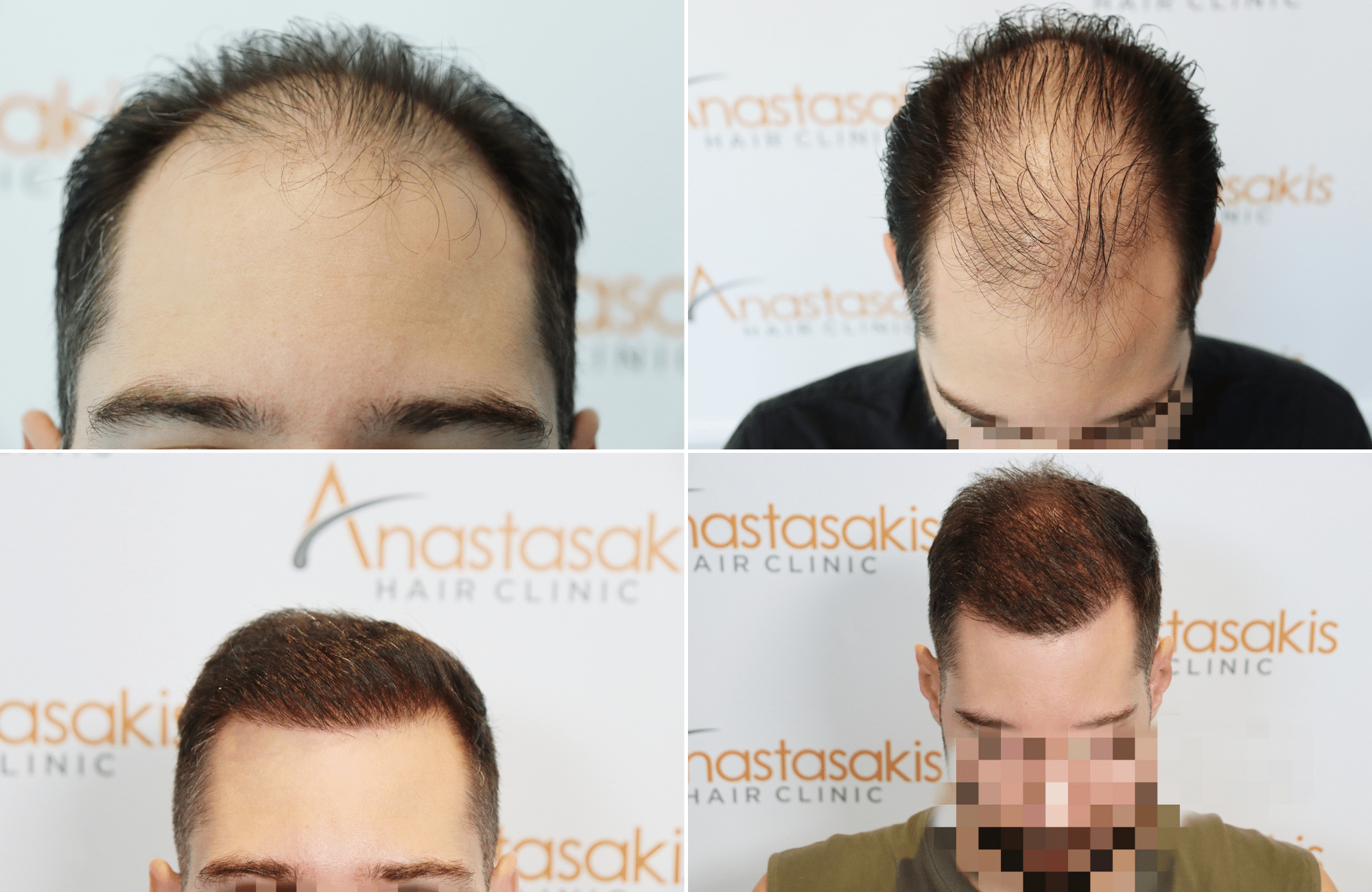 https://www.anastasakishairclinic.gr/portfolio/apotelesma-metamosxefsis-mallion-anastasakis-hair-clinic-536/