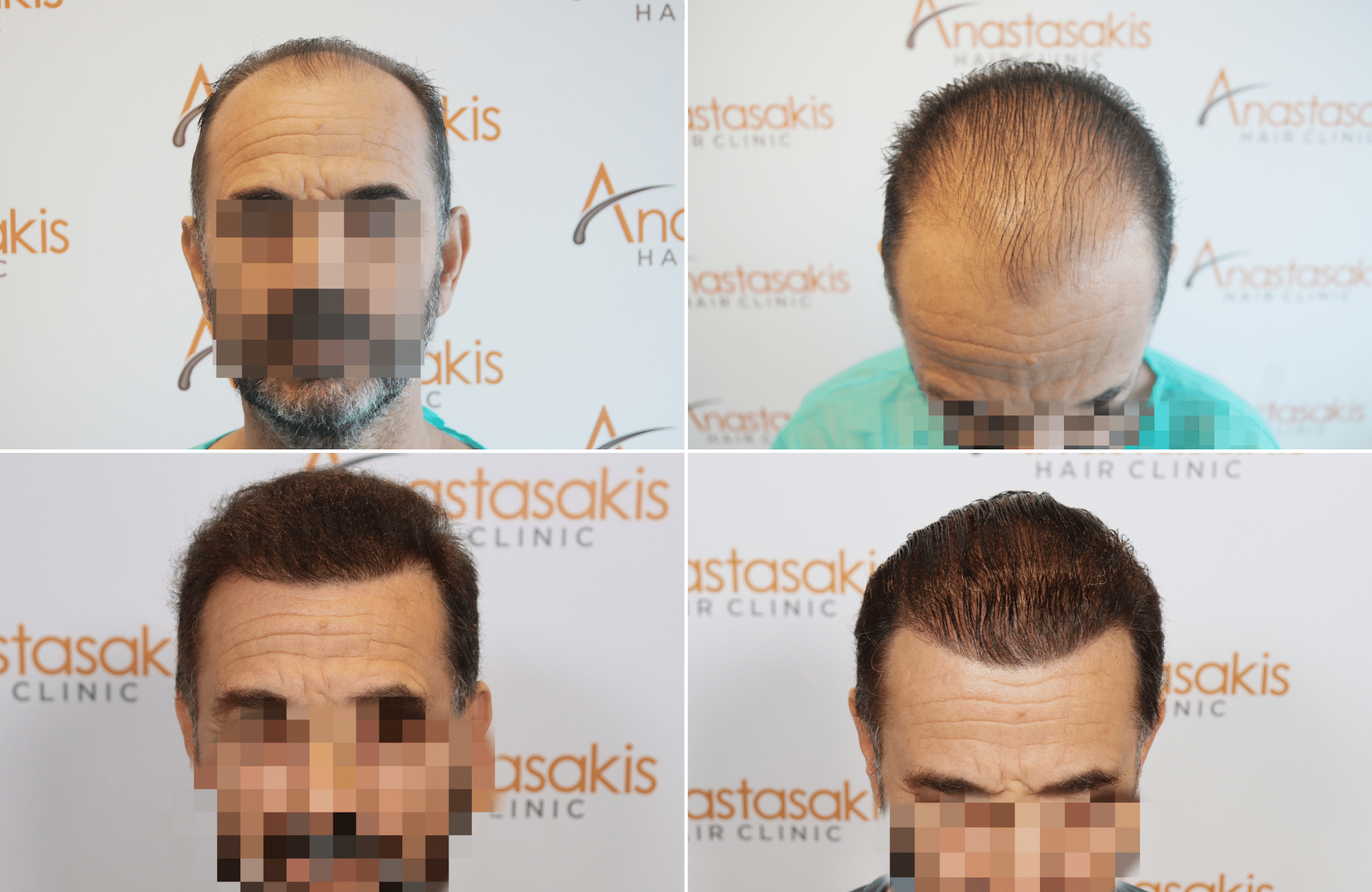 https://www.anastasakishairclinic.gr/portfolio/apotelesma-metamosxefsis-mallion-anastasakis-hair-clinic-523/