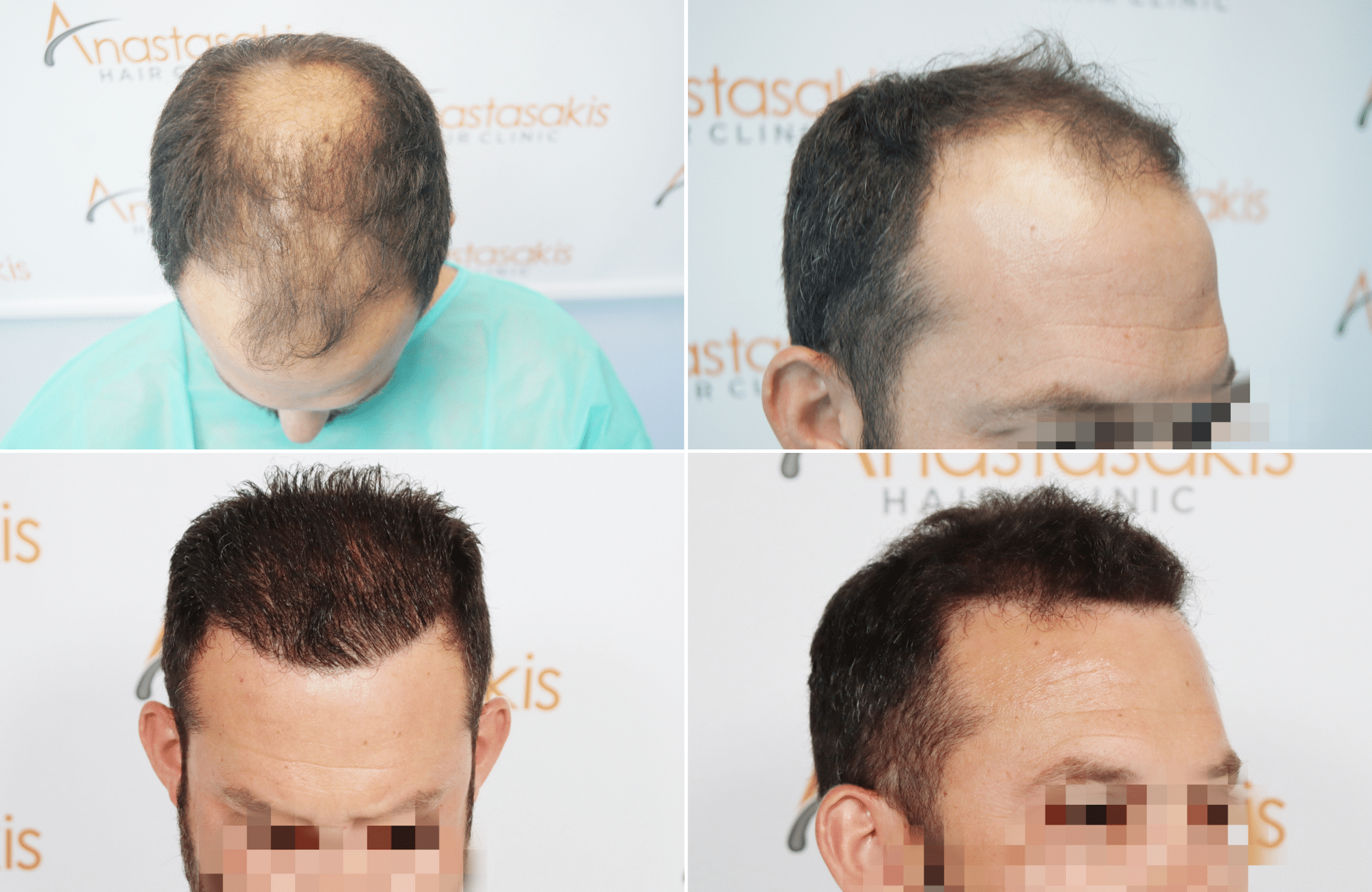 https://www.anastasakishairclinic.gr/portfolio/apotelesma-metamosxefsis-mallion-anastasakis-hair-clinic-525/