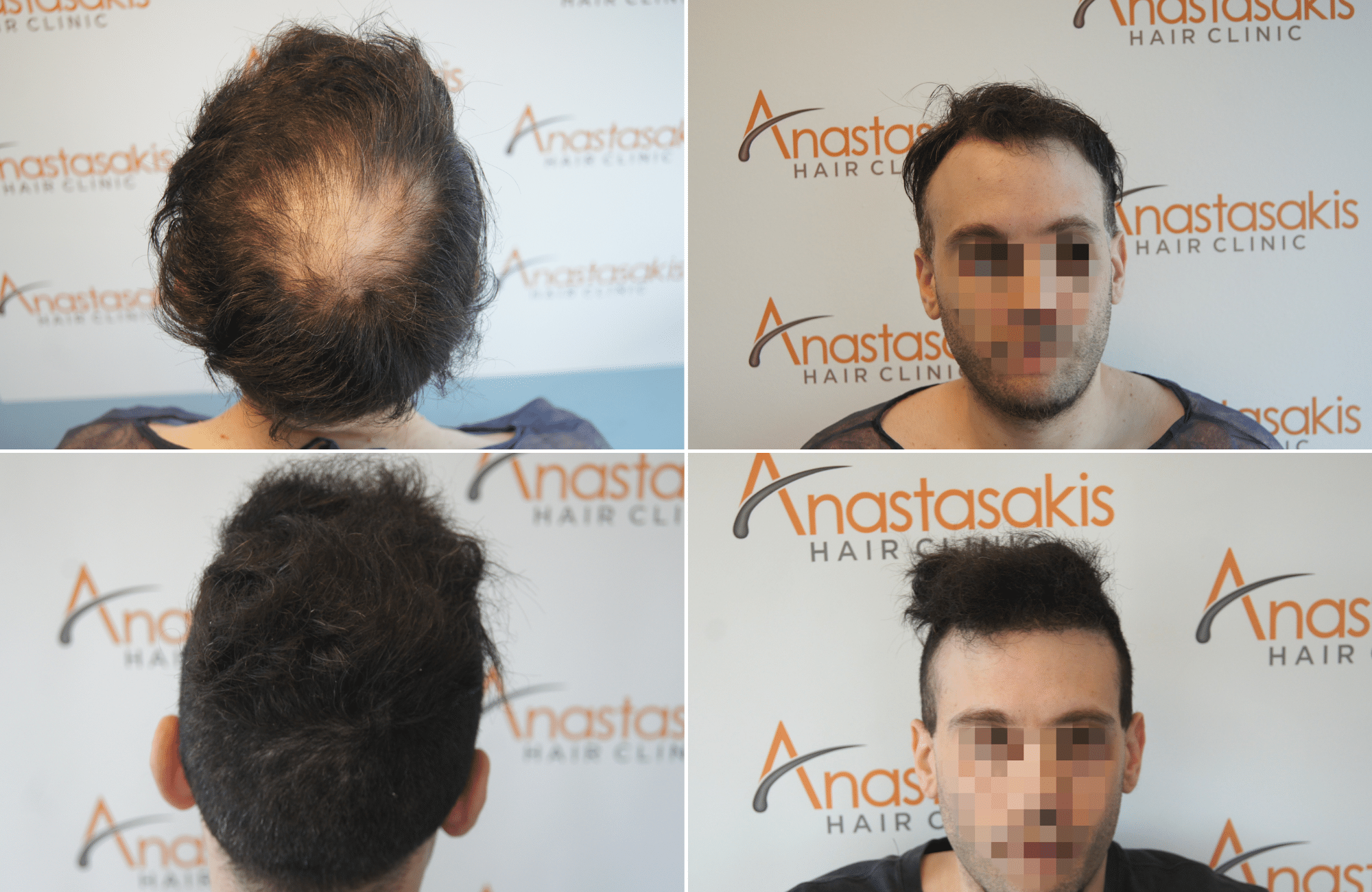 https://www.anastasakishairclinic.gr/portfolio/apotelesma-metamosxefsis-mallion-anastasakis-hair-clinic-555/