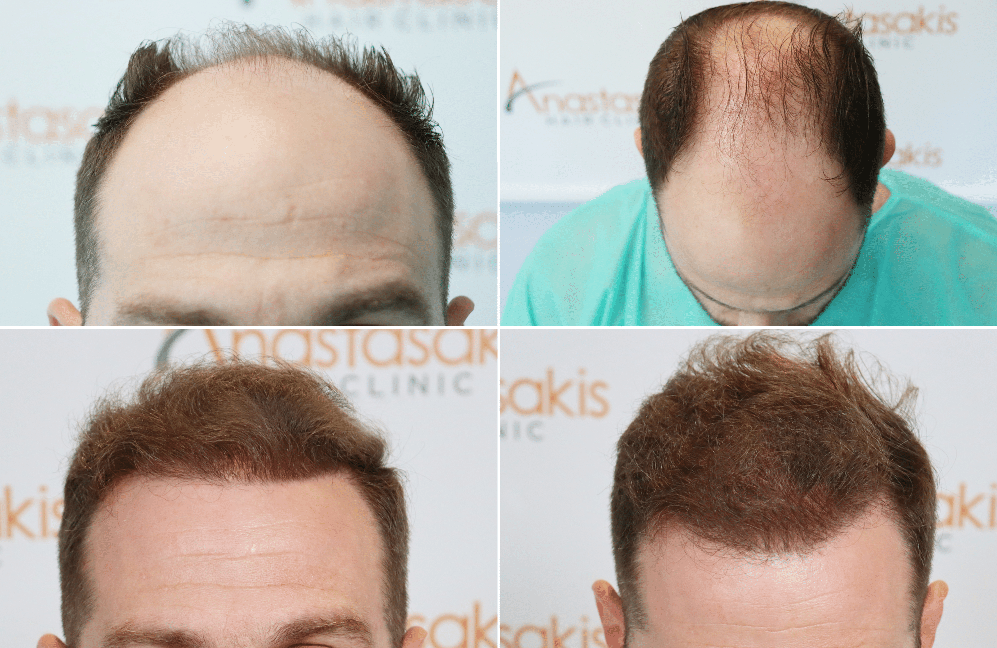 https://www.anastasakishairclinic.gr/portfolio/apotelesma-metamosxefsis-mallion-anastasakis-hair-clinic-542/