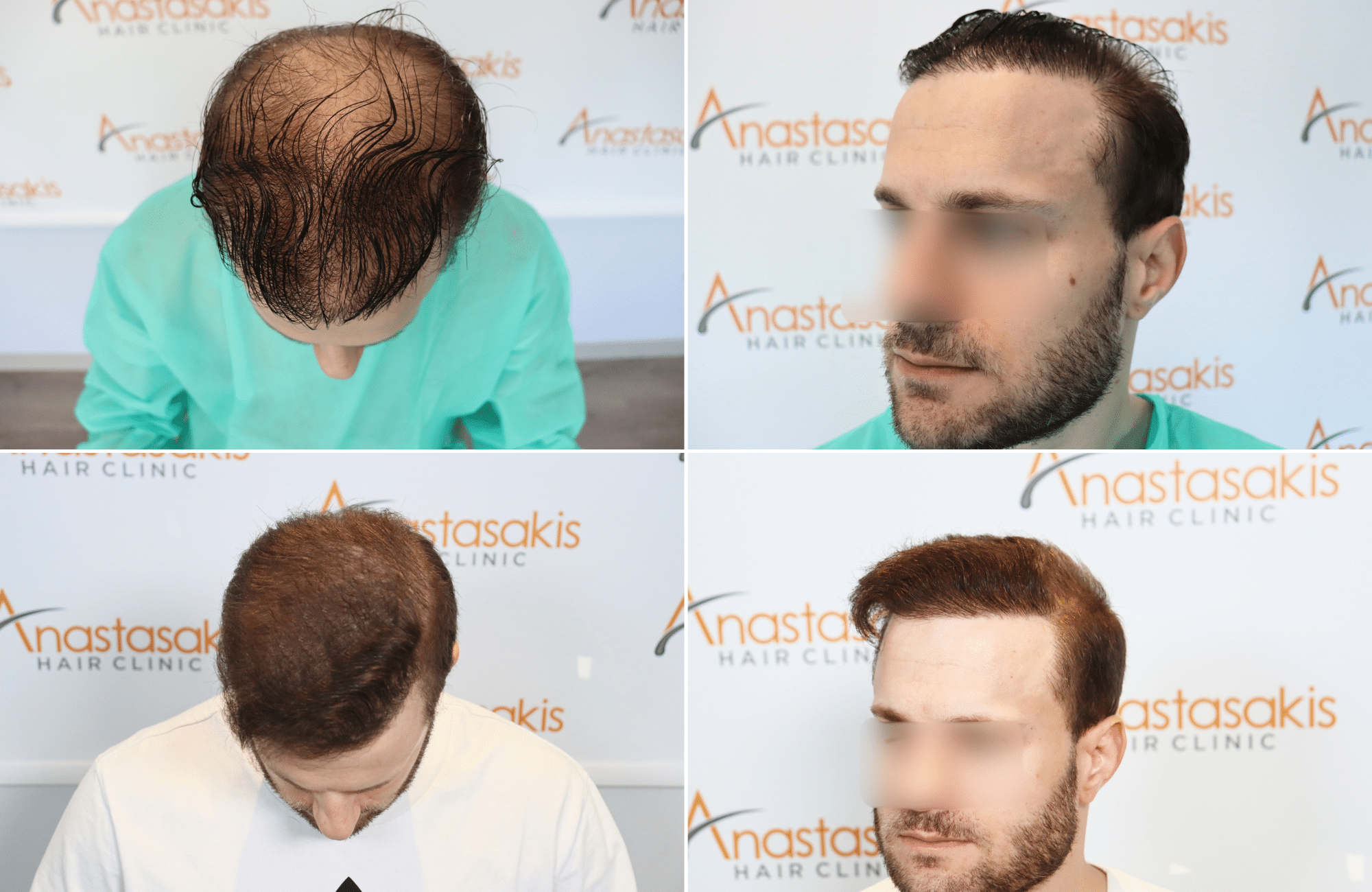 https://www.anastasakishairclinic.gr/portfolio/apotelesma-metamosxefsis-mallion-anastasakis-hair-clinic-541/