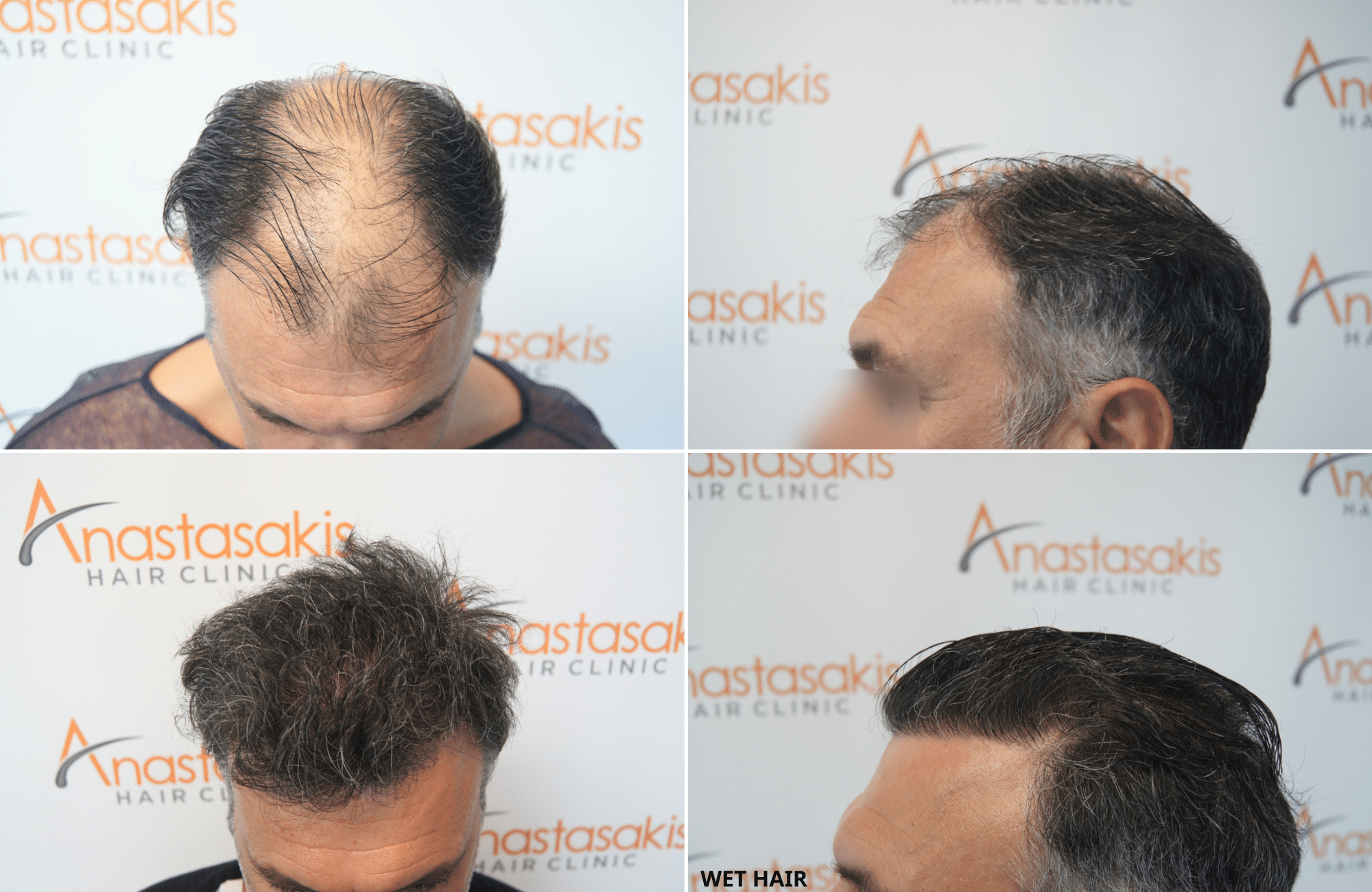https://www.anastasakishairclinic.gr/portfolio/apotelesma-metamosxefsis-mallion-anastasakis-hair-clinic-554/
