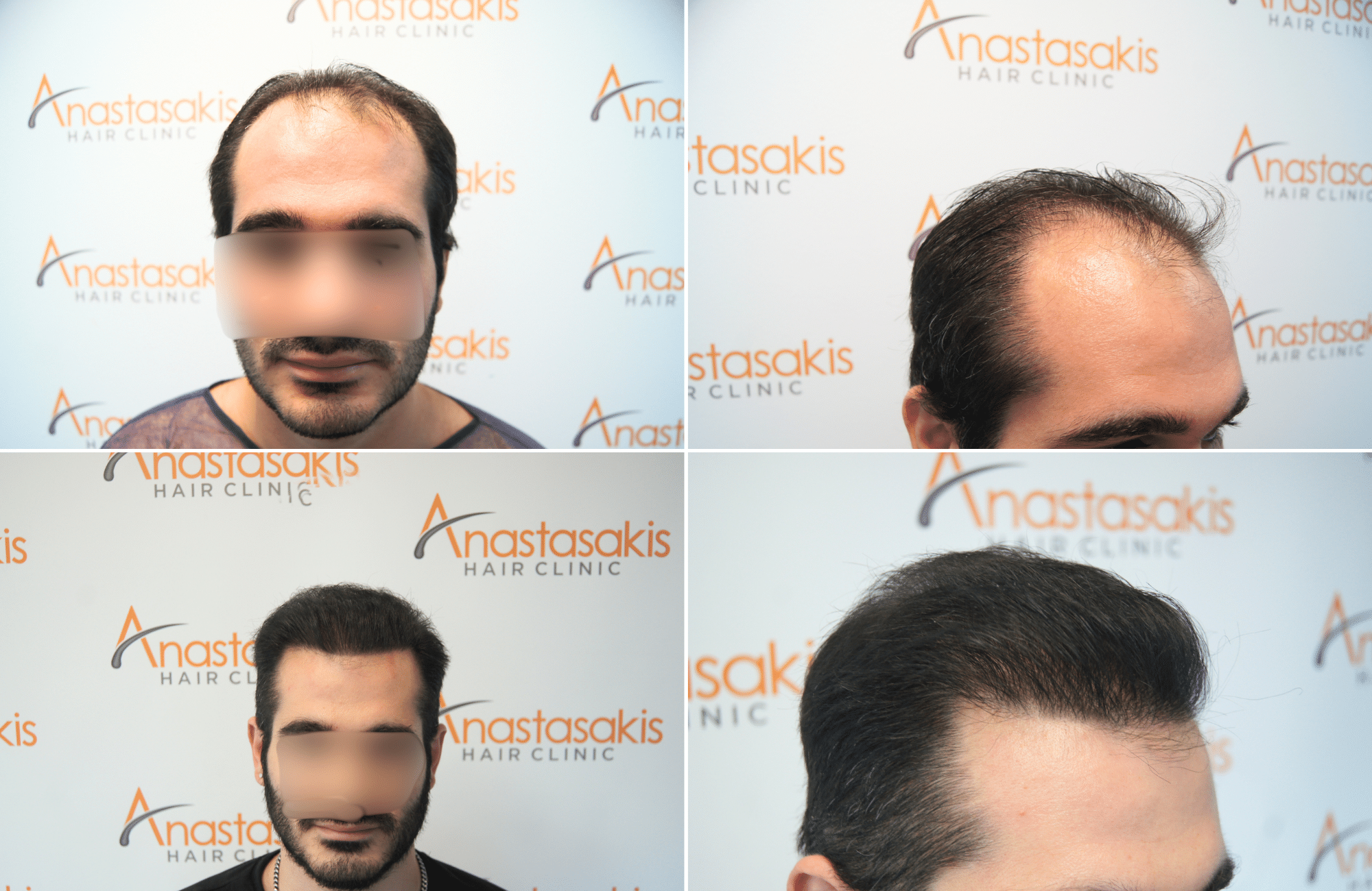 https://www.anastasakishairclinic.gr/portfolio/apotelesma-metamosxefsis-mallion-anastasakis-hair-clinic-550/