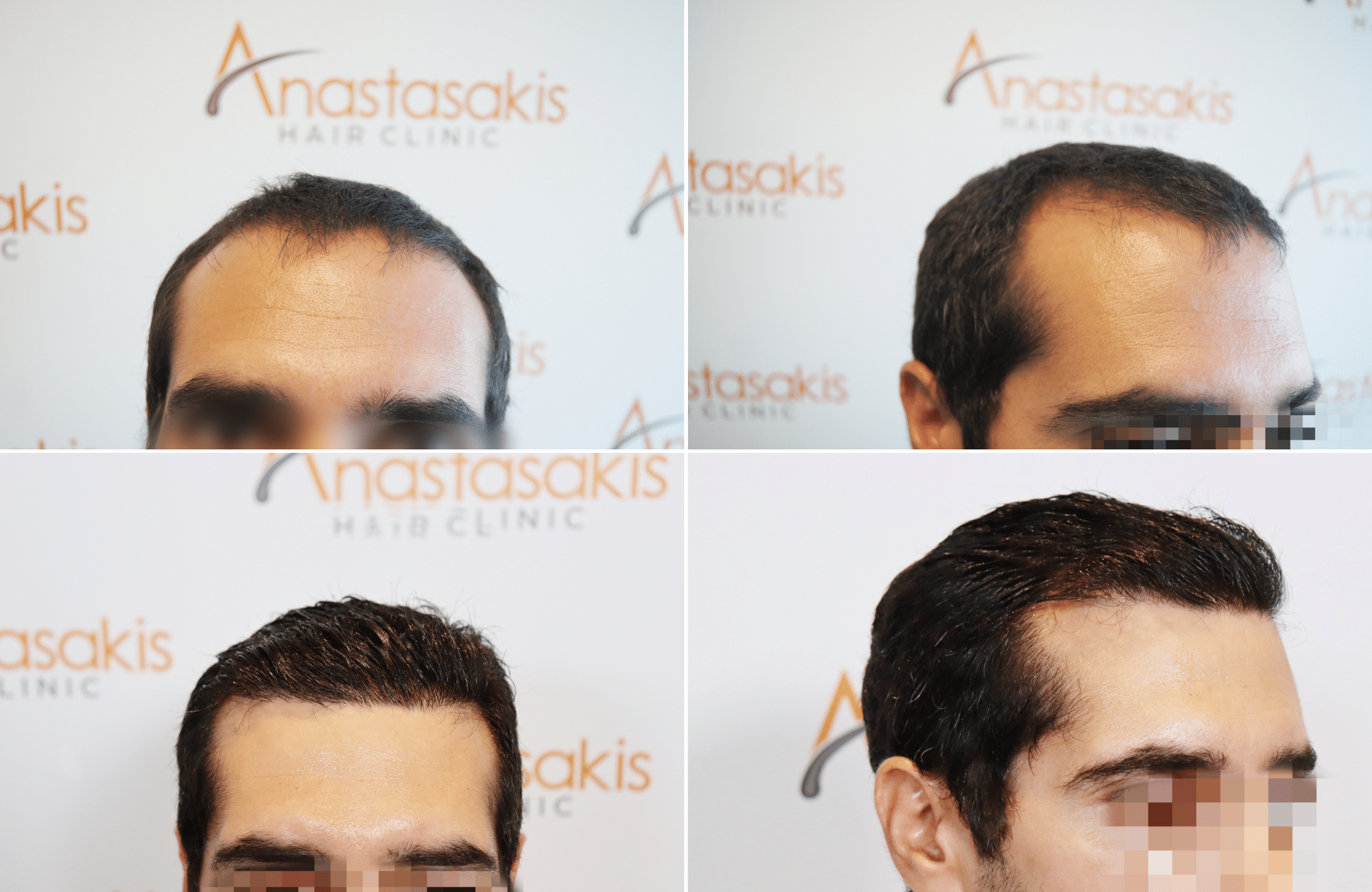 https://www.anastasakishairclinic.gr/portfolio/apotelesma-metamosxefsis-mallion-anastasakis-hair-clinic-532/