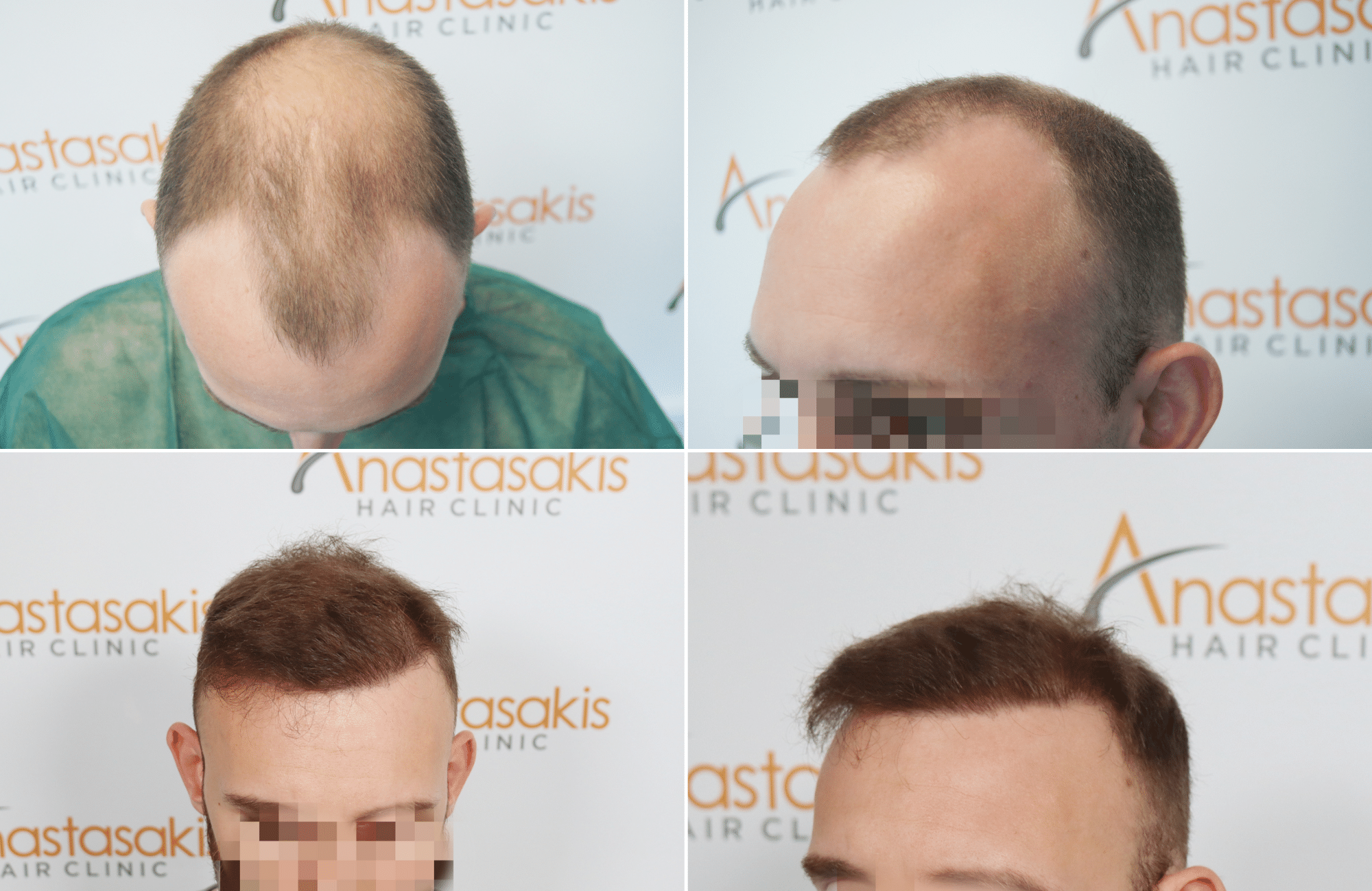 https://www.anastasakishairclinic.gr/portfolio/apotelesma-metamosxefsis-mallion-anastasakis-hair-clinic-530/