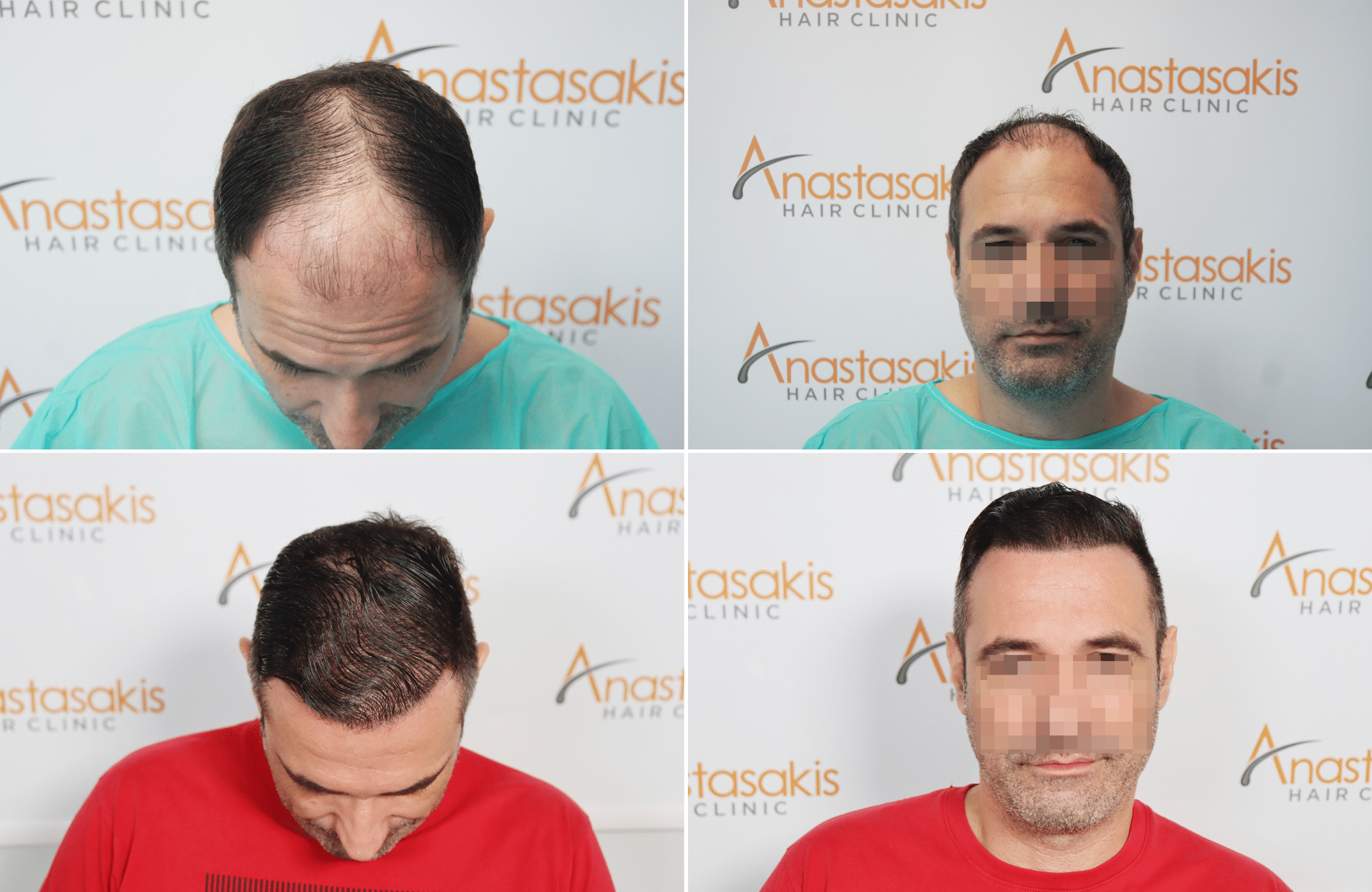 https://www.anastasakishairclinic.gr/portfolio/apotelesma-metamosxefsis-mallion-anastasakis-hair-clinic-535/