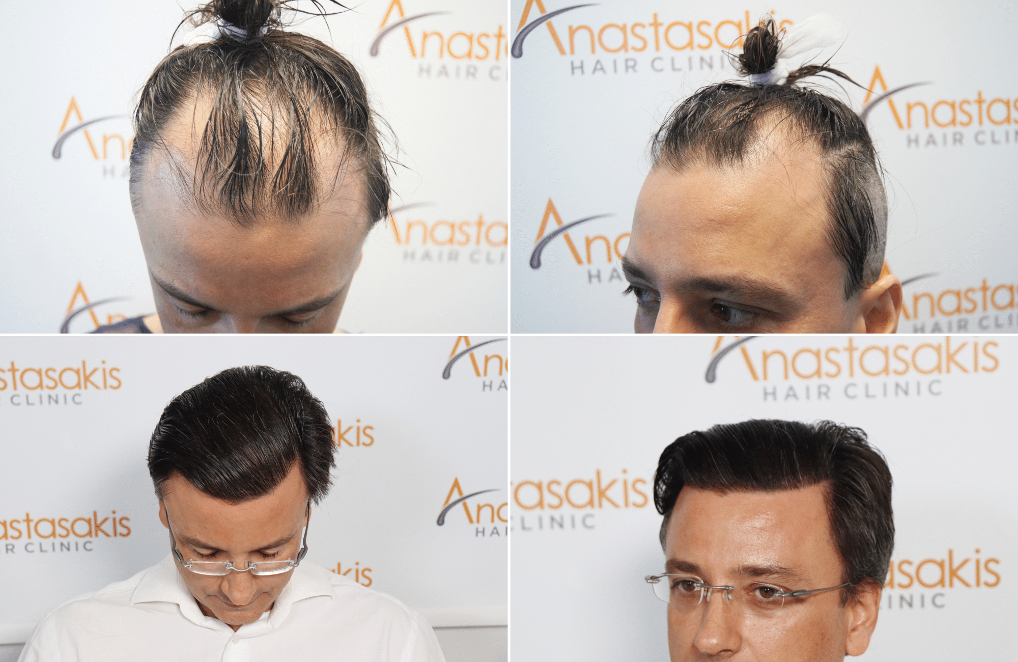 https://www.anastasakishairclinic.gr/portfolio/apotelesma-metamosxefsis-mallion-anastasakis-hair-clinic-543/