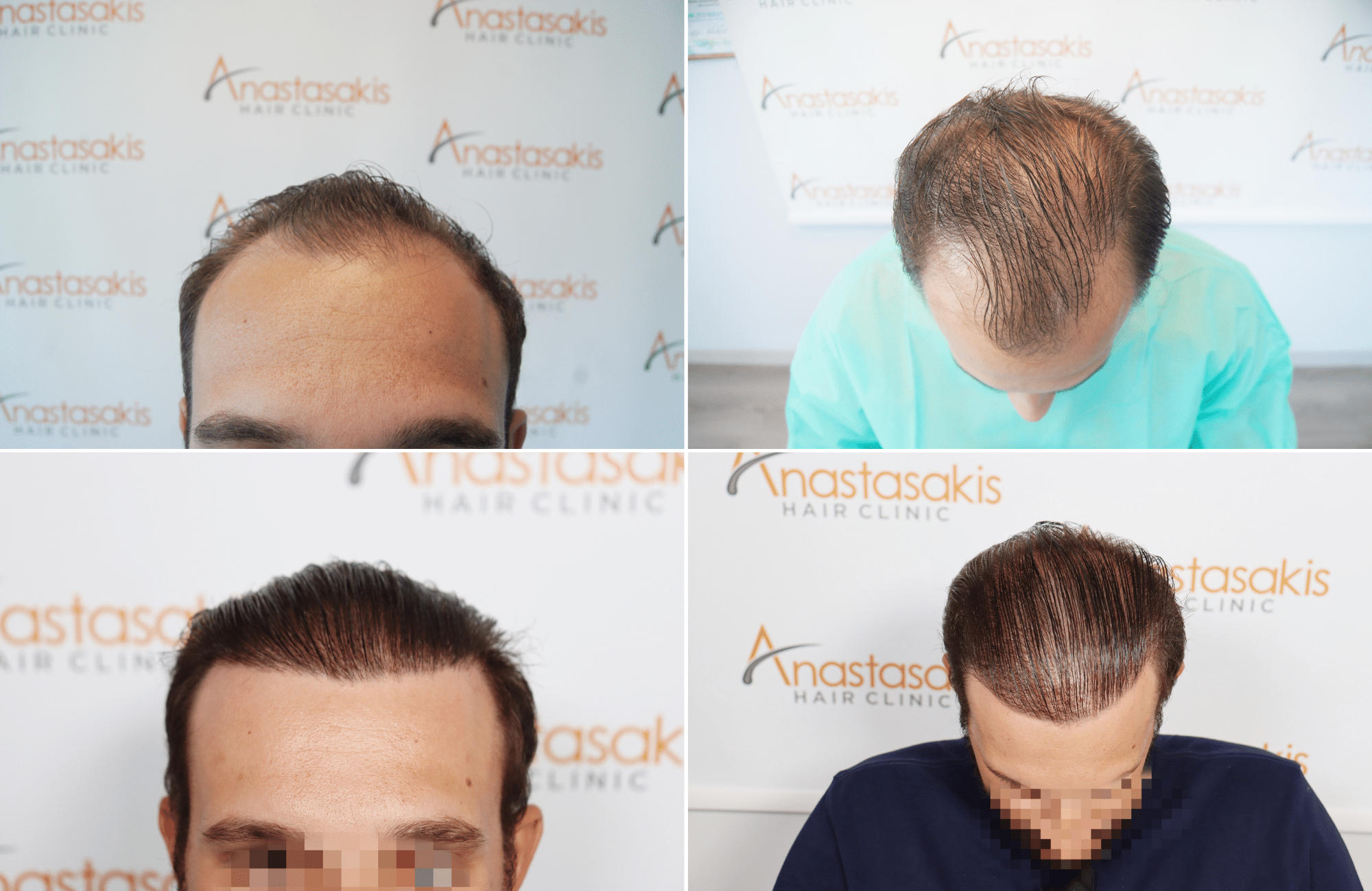 https://www.anastasakishairclinic.gr/portfolio/apotelesma-metamosxefsis-mallion-anastasakis-hair-clinic-526/