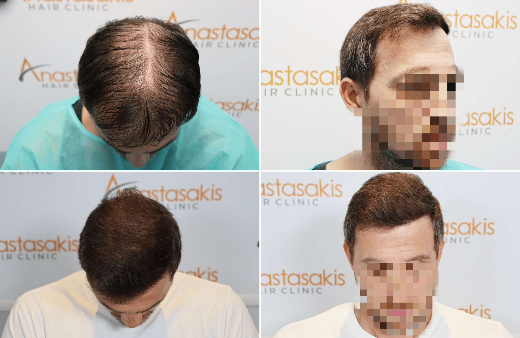https://www.anastasakishairclinic.gr/portfolio/apotelesma-metamosxefsis-mallion-anastasakis-hair-clinic-521/