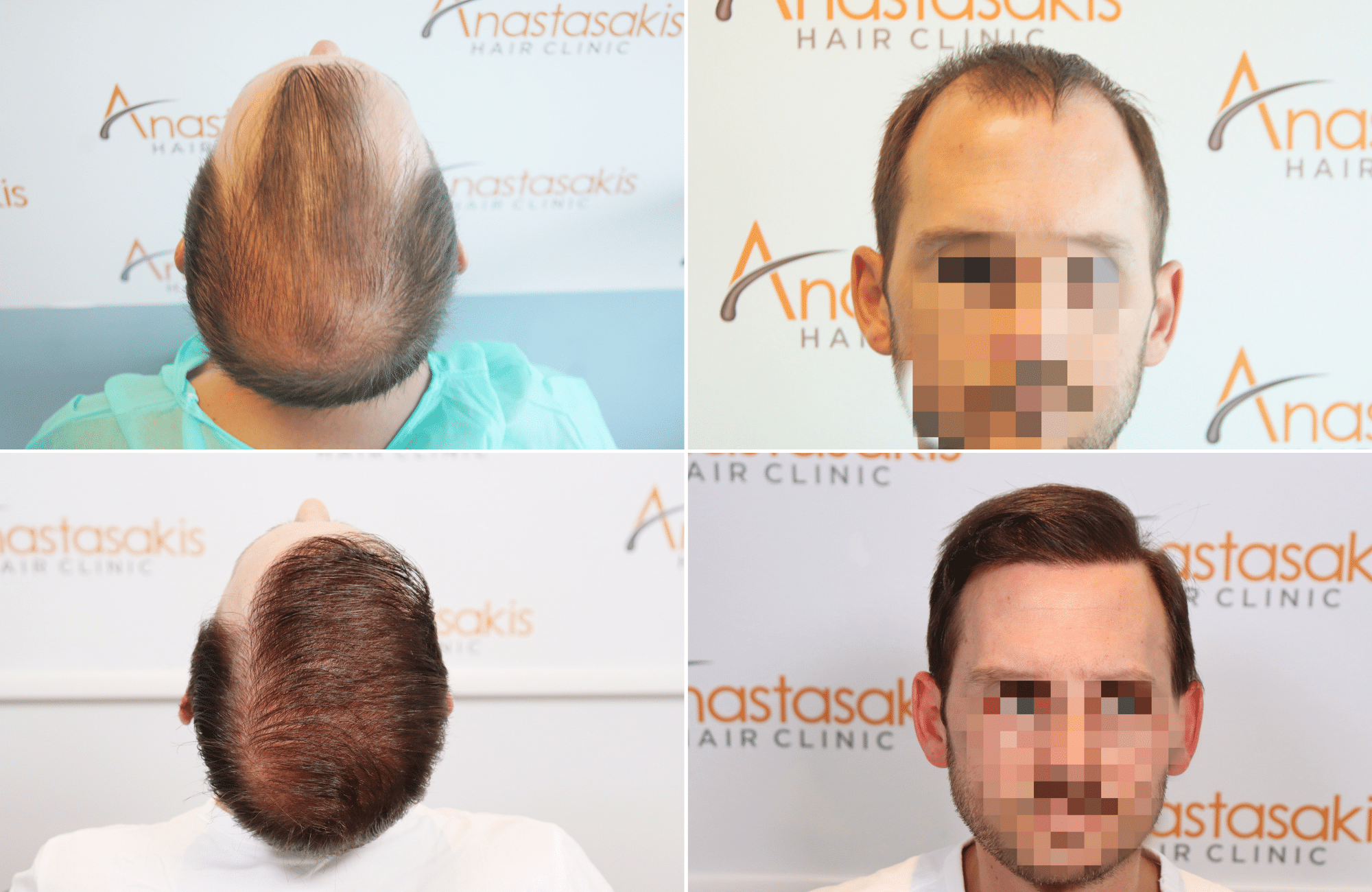 https://www.anastasakishairclinic.gr/portfolio/apotelesma-metamosxefsis-mallion-anastasakis-hair-clinic-514/
