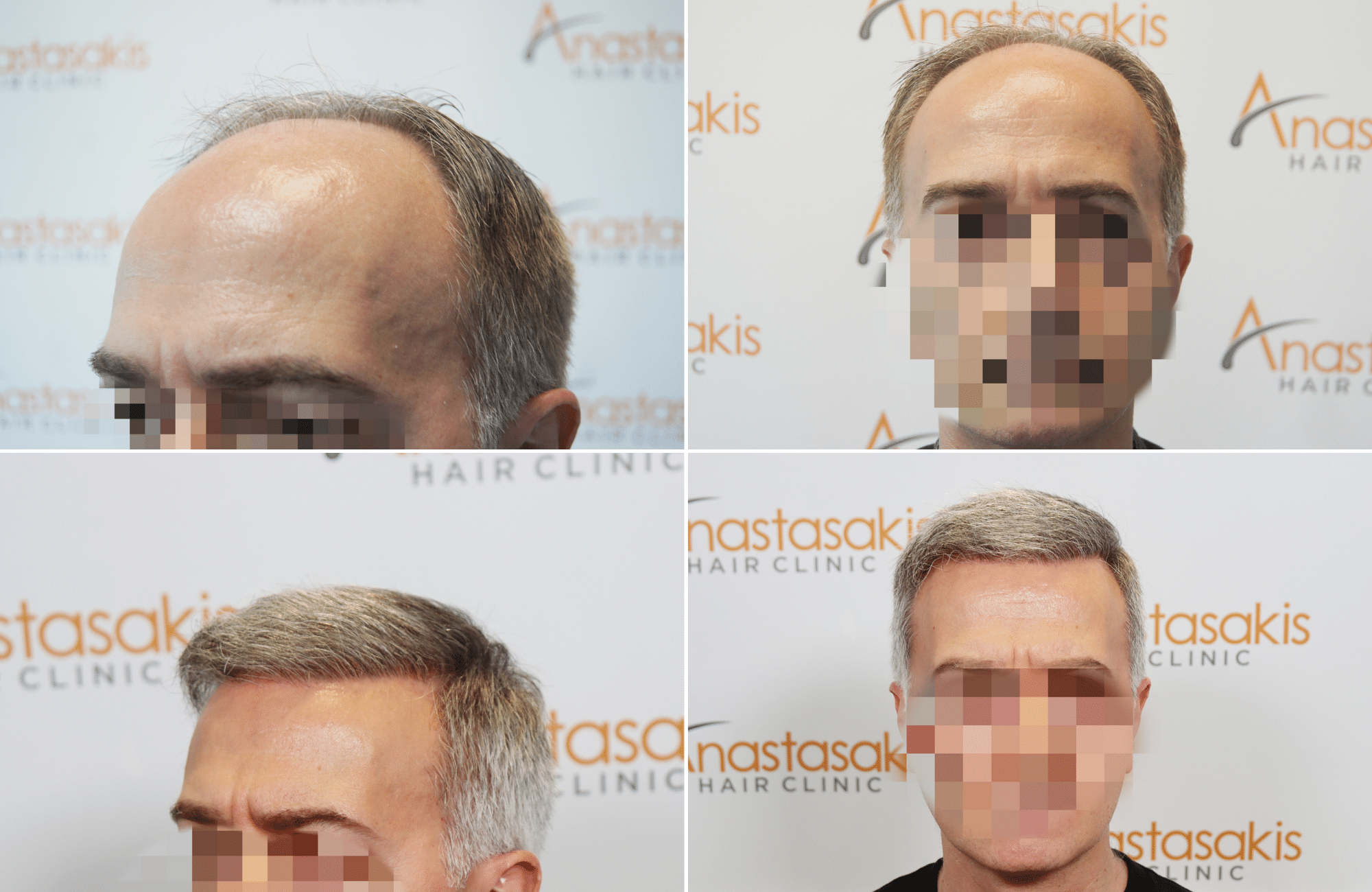 https://www.anastasakishairclinic.gr/portfolio/apotelesma-metamosxefsis-mallion-anastasakis-hair-clinic-537/