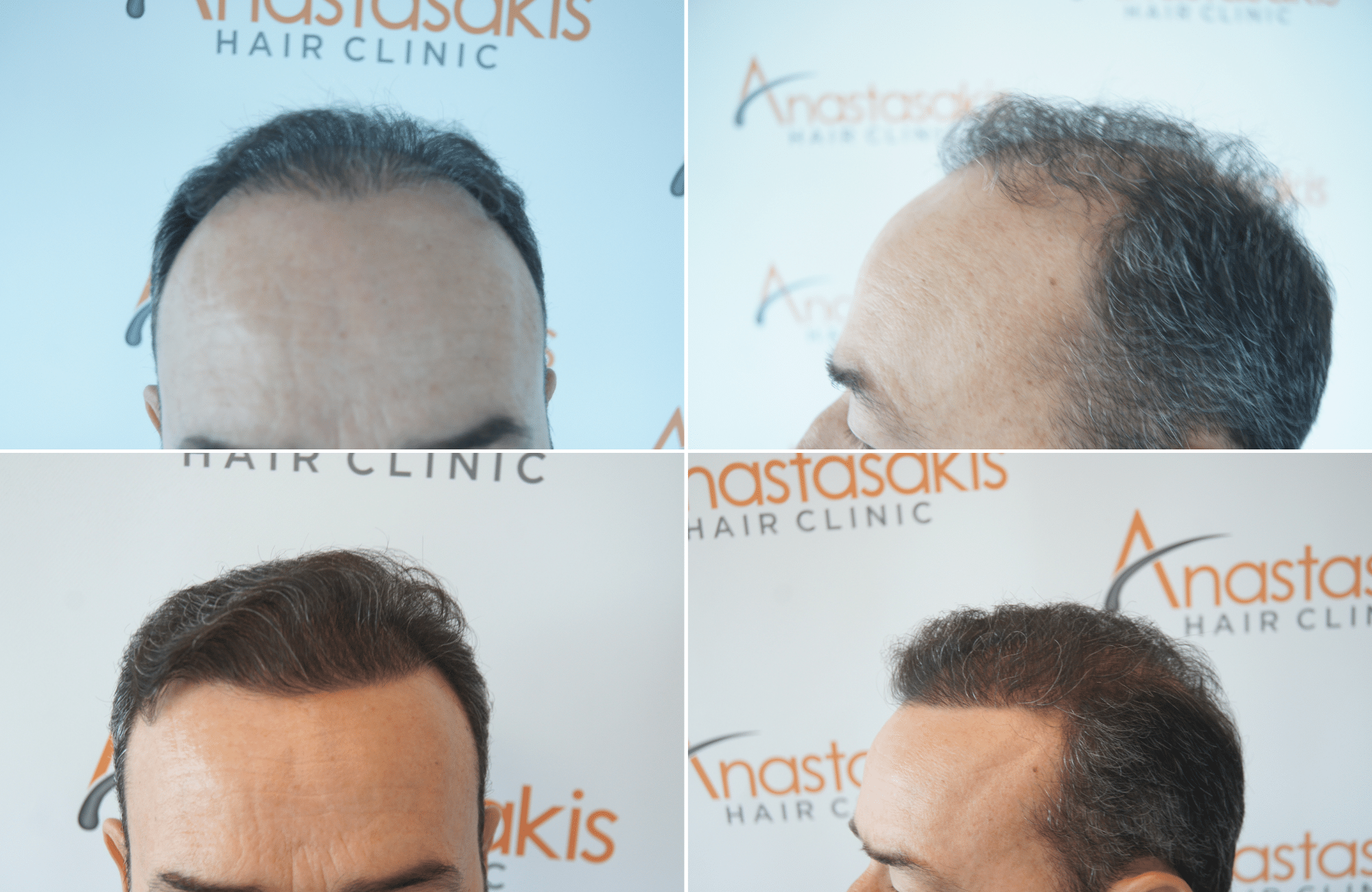 https://www.anastasakishairclinic.gr/portfolio/apotelesma-metamosxefsis-mallion-anastasakis-hair-clinic-552/