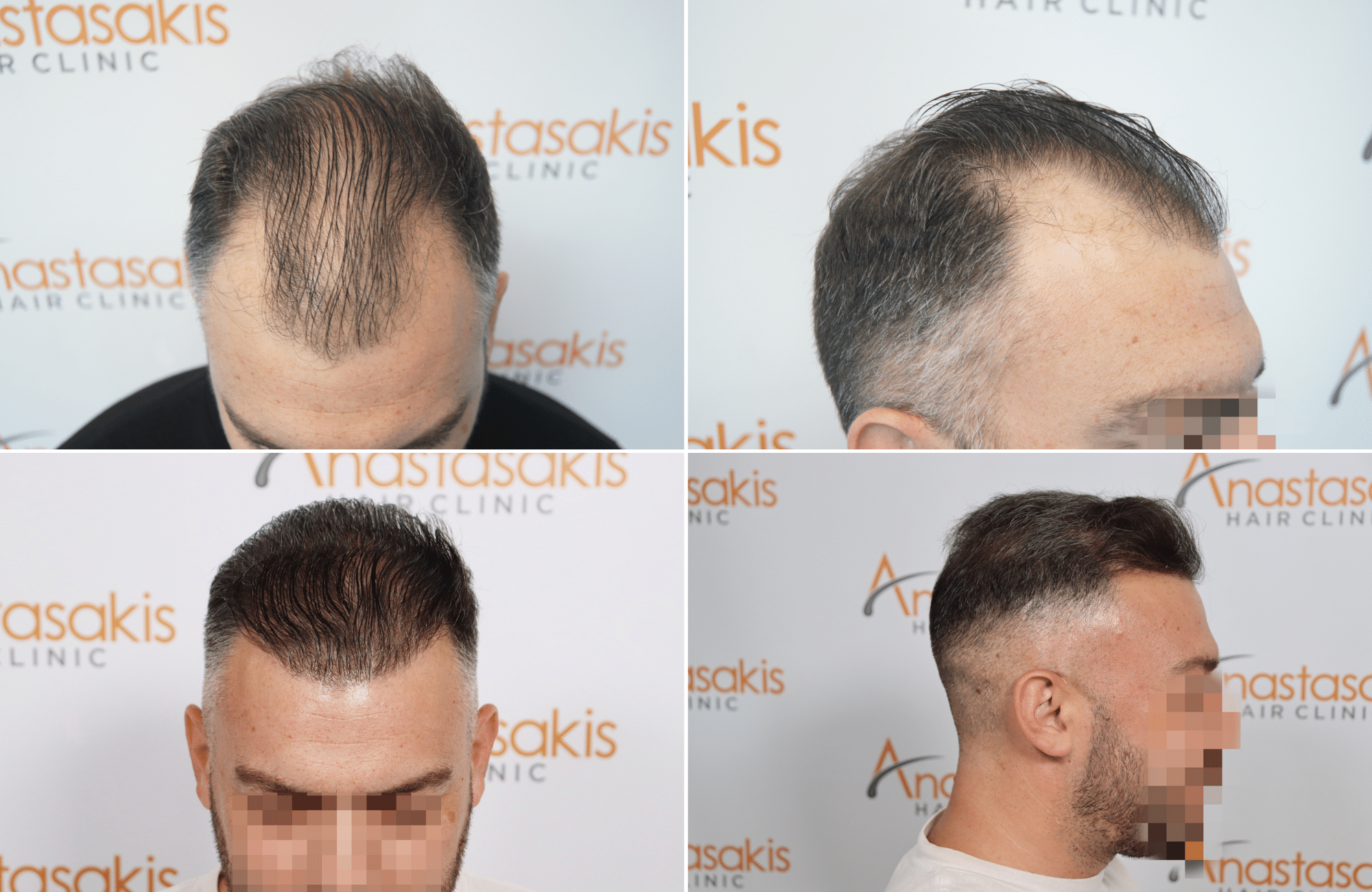 https://www.anastasakishairclinic.gr/portfolio/apotelesma-metamosxefsis-mallion-anastasakis-hair-clinic-519/