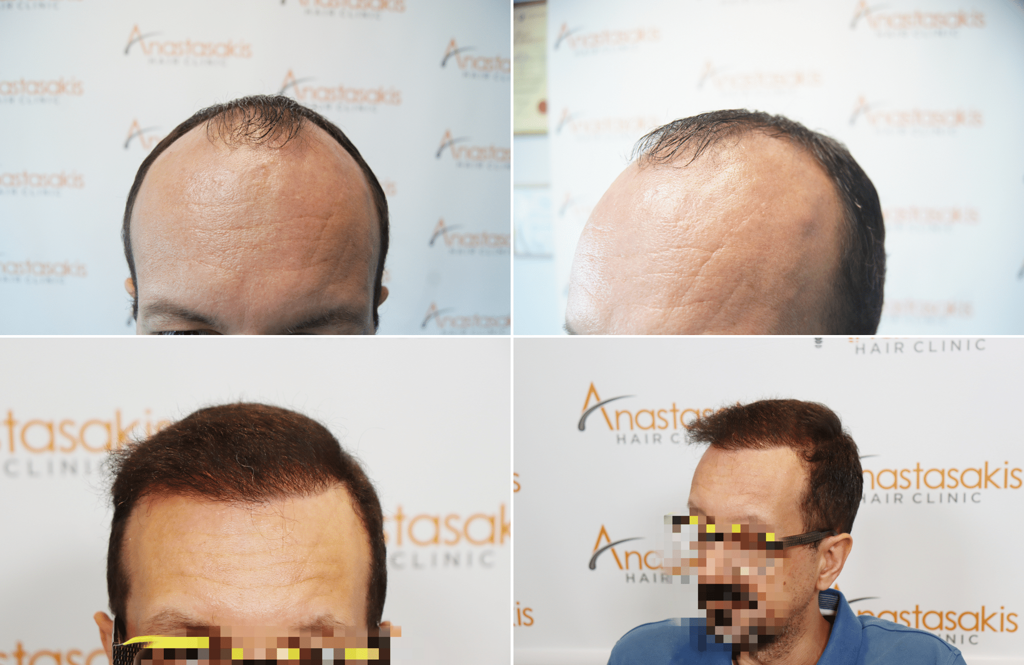 https://www.anastasakishairclinic.gr/portfolio/apotelesma-metamosxefsis-mallion-anastasakis-hair-clinic-522/