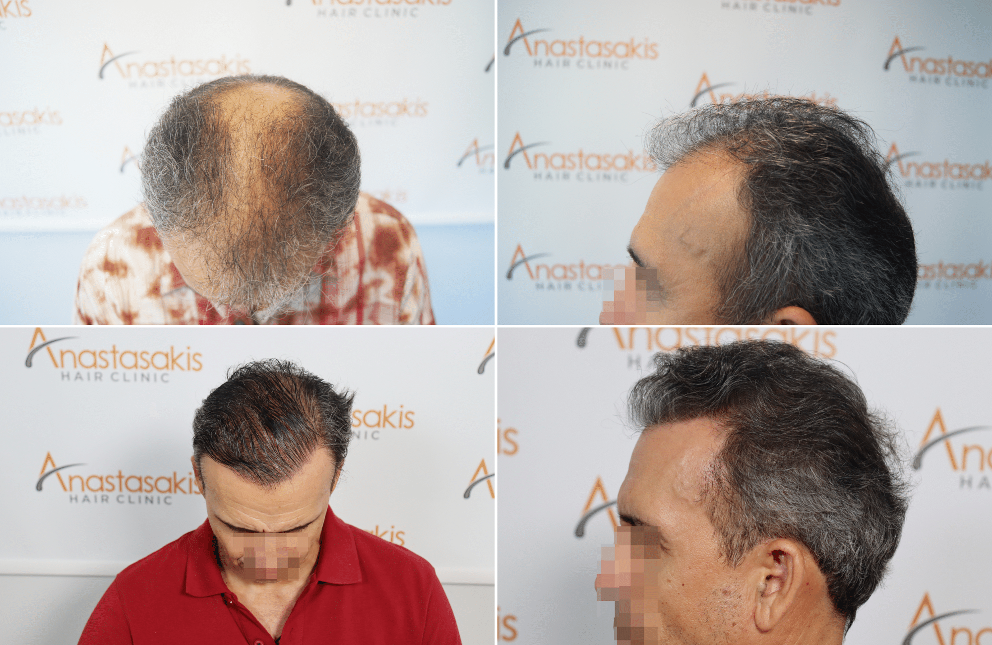 https://www.anastasakishairclinic.gr/portfolio/apotelesma-metamosxefsis-mallion-anastasakis-hair-clinic-520/