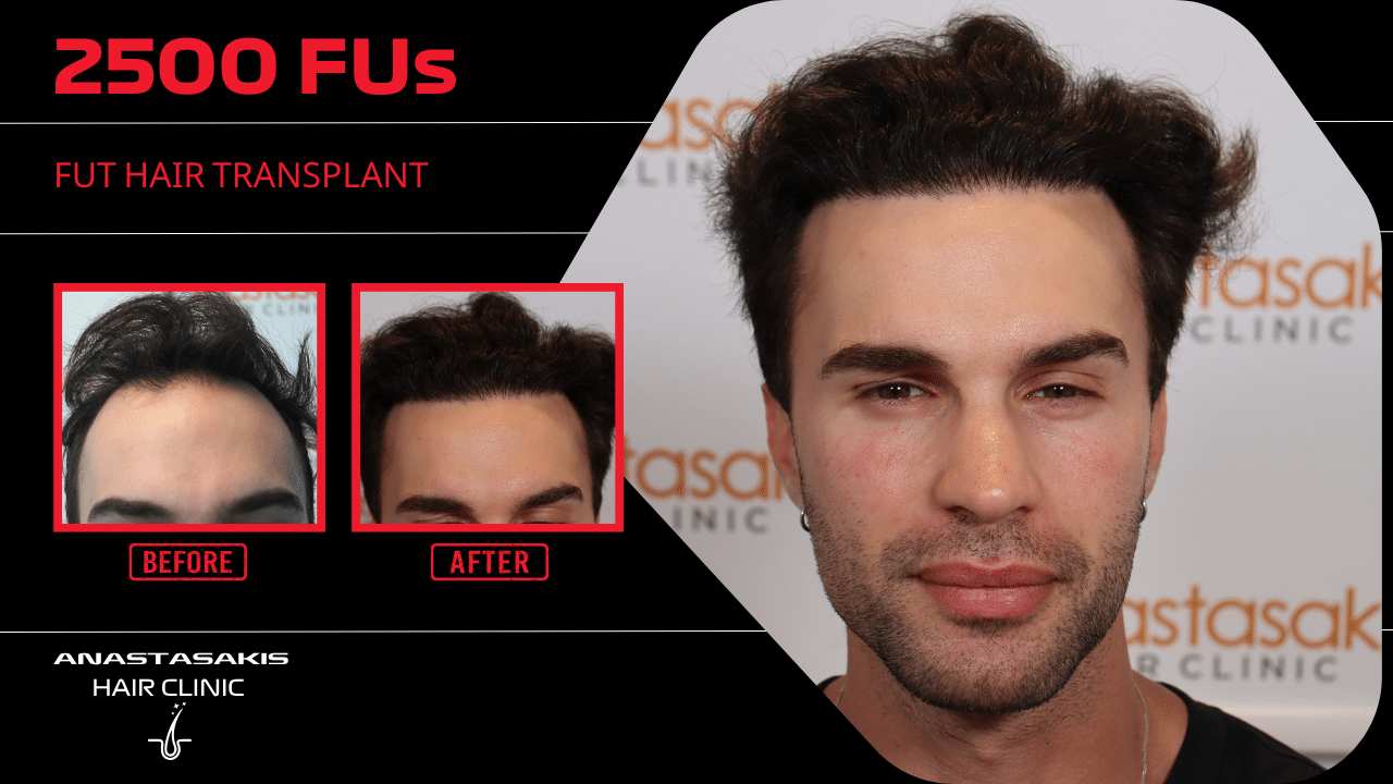 Anastasakis Hair Clinic