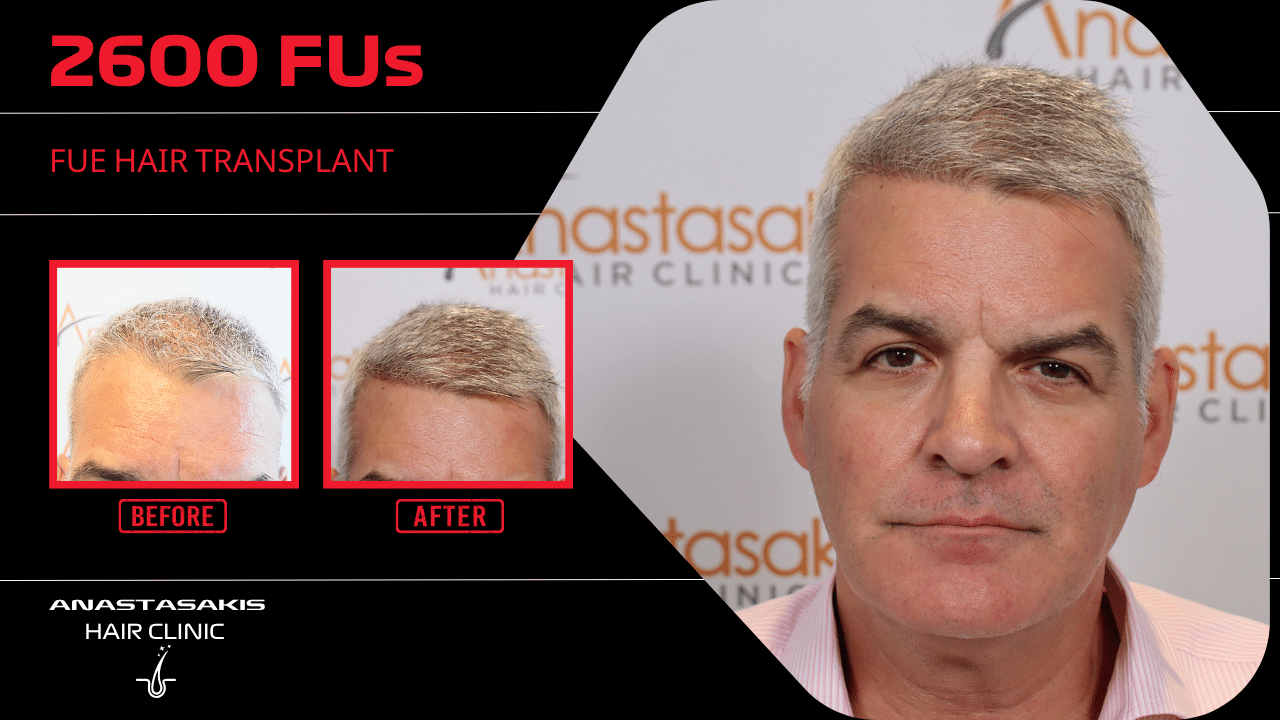 Anastasakis Hair Clinic