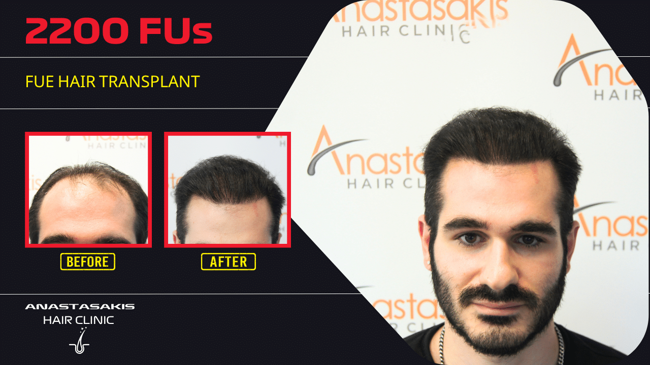 Anastasakis Hair Clinic